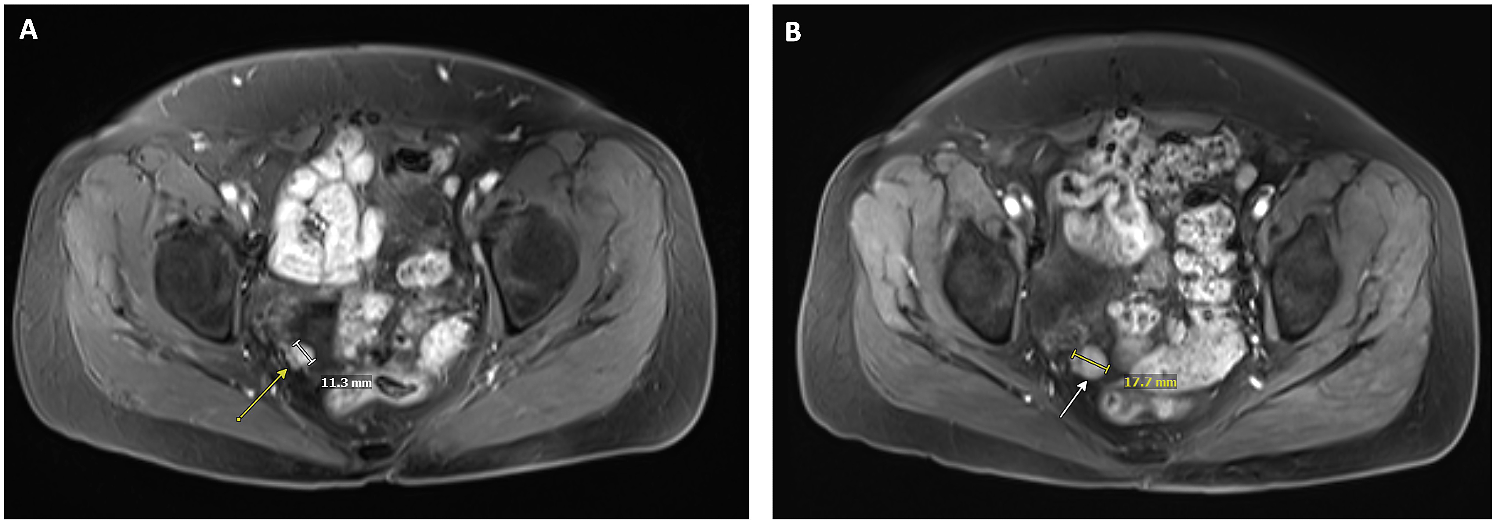 Patient 2 MRI scans. (A) Baseline T1 post contrast MRI shows
peritoneal nodule (arrow). (B) Follow up T1 post contrast MRI at seven months
shows progression of disease with growth of peritoneal nodule (arrow).