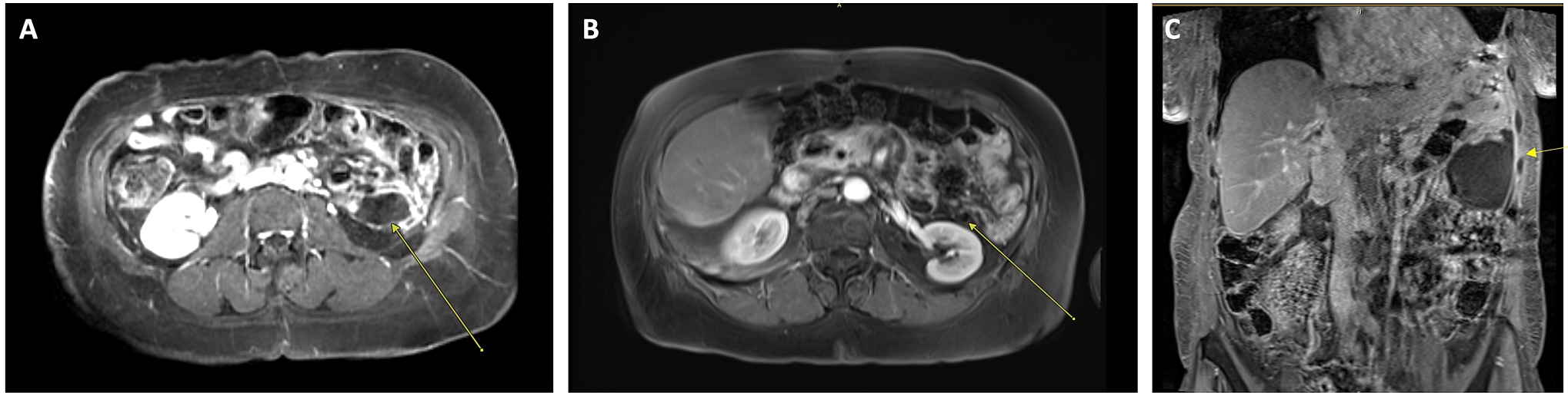 Patient 3 MRI scans. (A) Baseline T1 post contrast MRI shows
left perirenal mass (arrow). (B) Follow up T1 post contrast MRI at 24 months
shows partial response with decrease size of perirenal mass (arrow). (C) Follow
up T1 post contrast MRI at 46 months shows progressive disease with development
of new cystic mass (arrow).