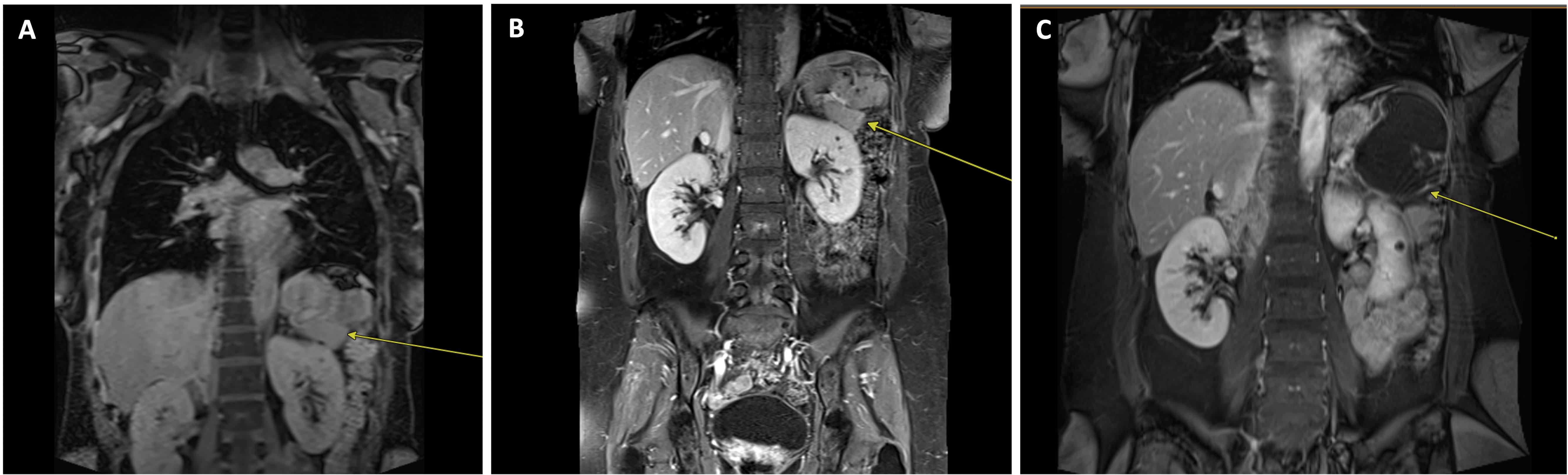 Patient 4 MRI scans. (A) Baseline T1 post contrast MRI shows
left splenic hilum mass (arrow). (B) Follow up T1 post contrast MRI at 4 months
shows stable splenic hilum mass (arrow). (C) Follow up T1 post contrast MRI at 15
months shows progressive disease with increase size of splenic hilum mass
(arrow).