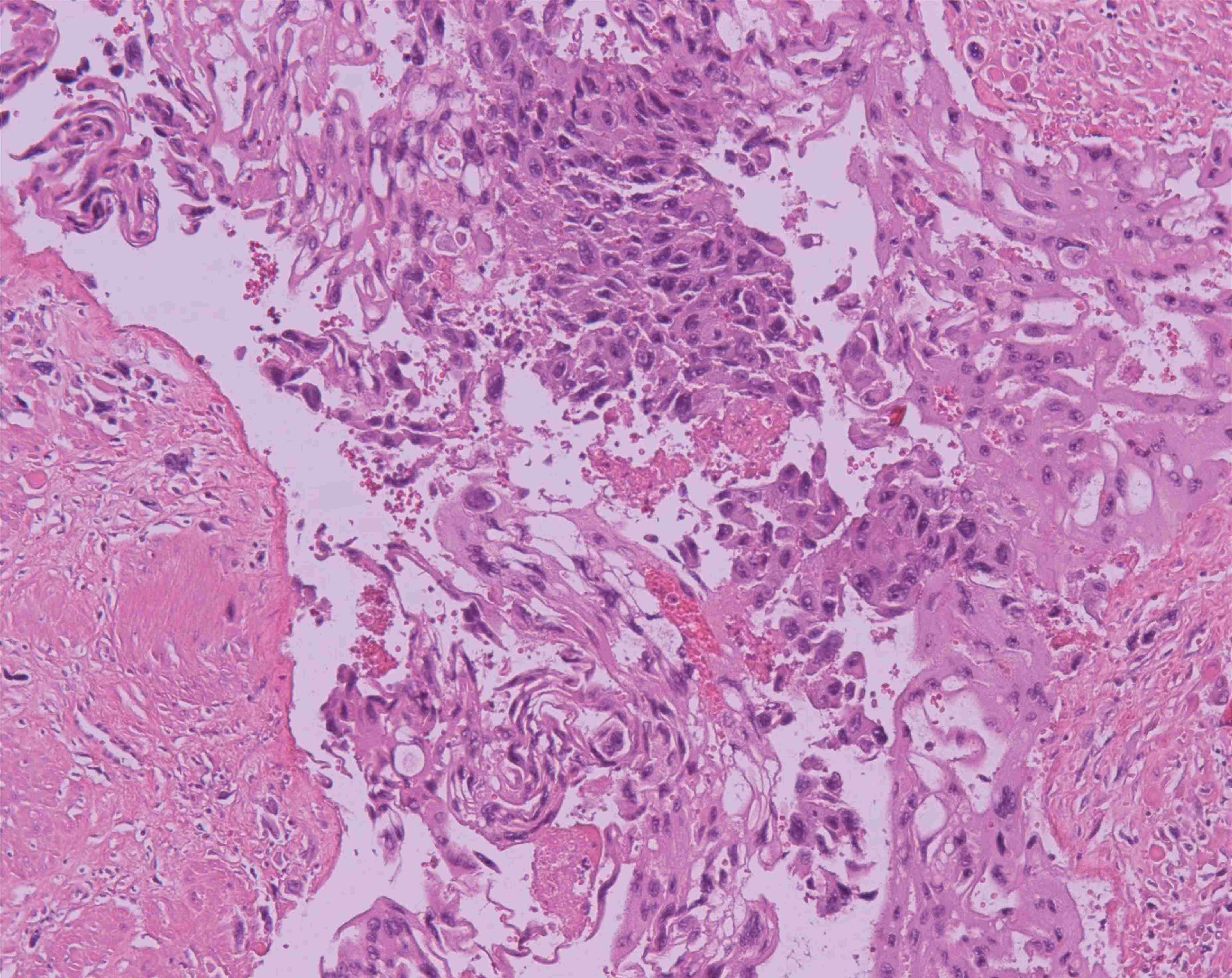 H&E stain of choriocarcinoma cervix. The tissue section shows
fragments of malignant neoplasm, sheets of syncytiotrophoblast, cytotrophoblast
and intermediate trophoblastic cells, and extensive areas of hemorrhage and
necrosis. This image was viewed at 200 times magnification.