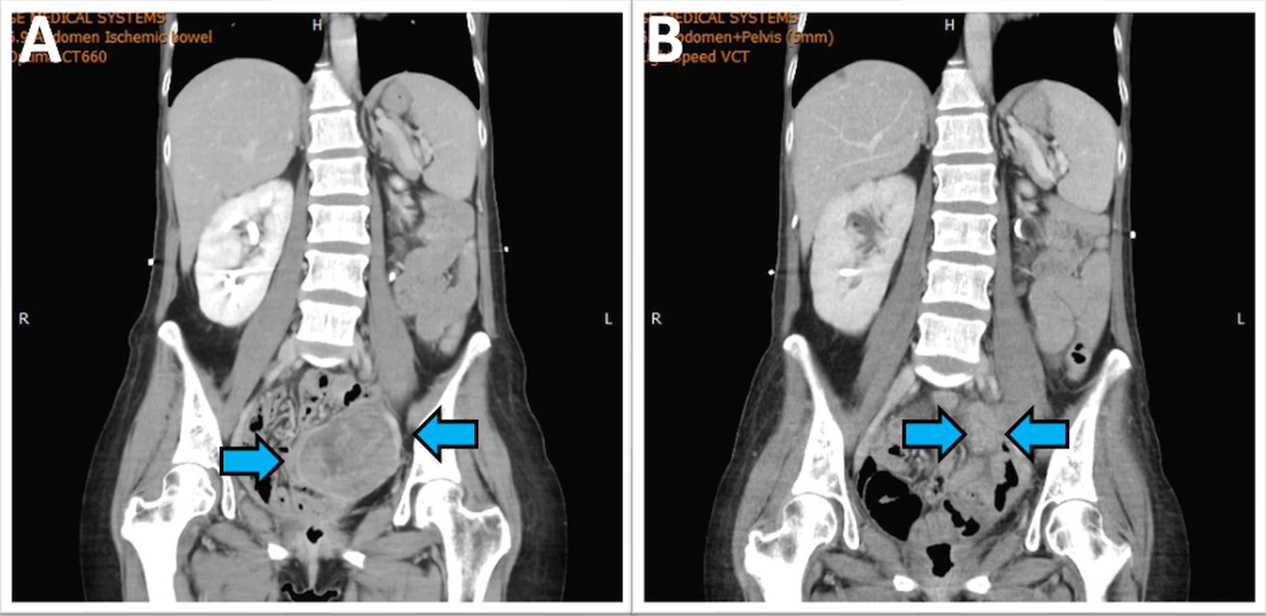 CT scan before and after dual combination therapy. This figure
illustrates the radiological response of a patient with recurrent clear cell
carcinoma who achieved a complete response and normalization of CA-125 following
treatment with pembrolizumab and bevacizumab. (A) Recurrent pelvic tumors (blue
arrow) detected in July 2021. (B) Significant regression of recurrent pelvic
tumors observed one month after initiation of pembrolizumab and bevacizumab
therapy.