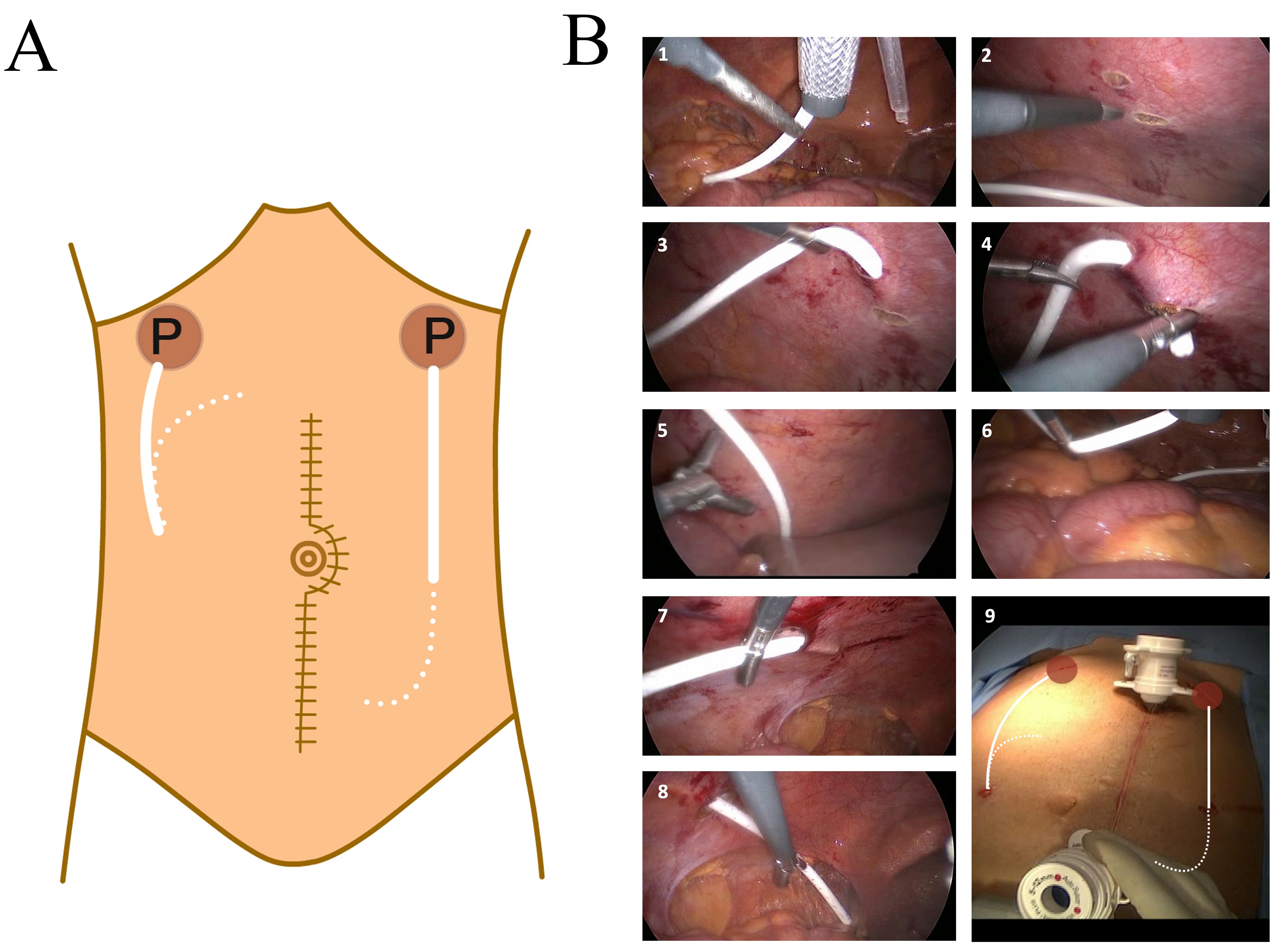 Figure showing the steps of port placement. (A) Schematic 
drawing of ports (P) placement. In this technique two ports are placed, one in 
the upper right quadrant the other is in the upper left quadrant either 
laparoscopically or during laparotomy. Two separate 5-cm incisions on the skin 
are created for placement of the portal chambers in the left upper and right 
upper quadrants just inferior to thorax at the midclavicular line. The 
subcutaneous tissue is dissected and pockets are developed to the level of the 
fascia. The catheters are placed from the lateral trocars and then brought 
through a subcutaneous tunnel to the site of the portal chambers. The tip of the 
left catheter is placed towards pelvis and the right one towards liver (dotted 
lines). (B) Intrabdominal placement of the catheters: (1) Left catheter is taken 
intraabdominally from the left lateral trocar. (2) A retroperitoneal tunnel is 
formed on the left lateral abdominal wall. (3) and (4) The catheter is passed 
through the tunnel. (5) The tip of the catheter is placed towards the liver. (6) 
Right catheter is inserted into the abdomen from the right lateral trocar. (7) A 
retroperitoneal tunnel is formed on the right lateral abdominal wall. (8) The 
right catheter is passed from the tunnel and placed facing the pelvis. (9) 
Postoperative picture of the abdomen showing the places of the ports.