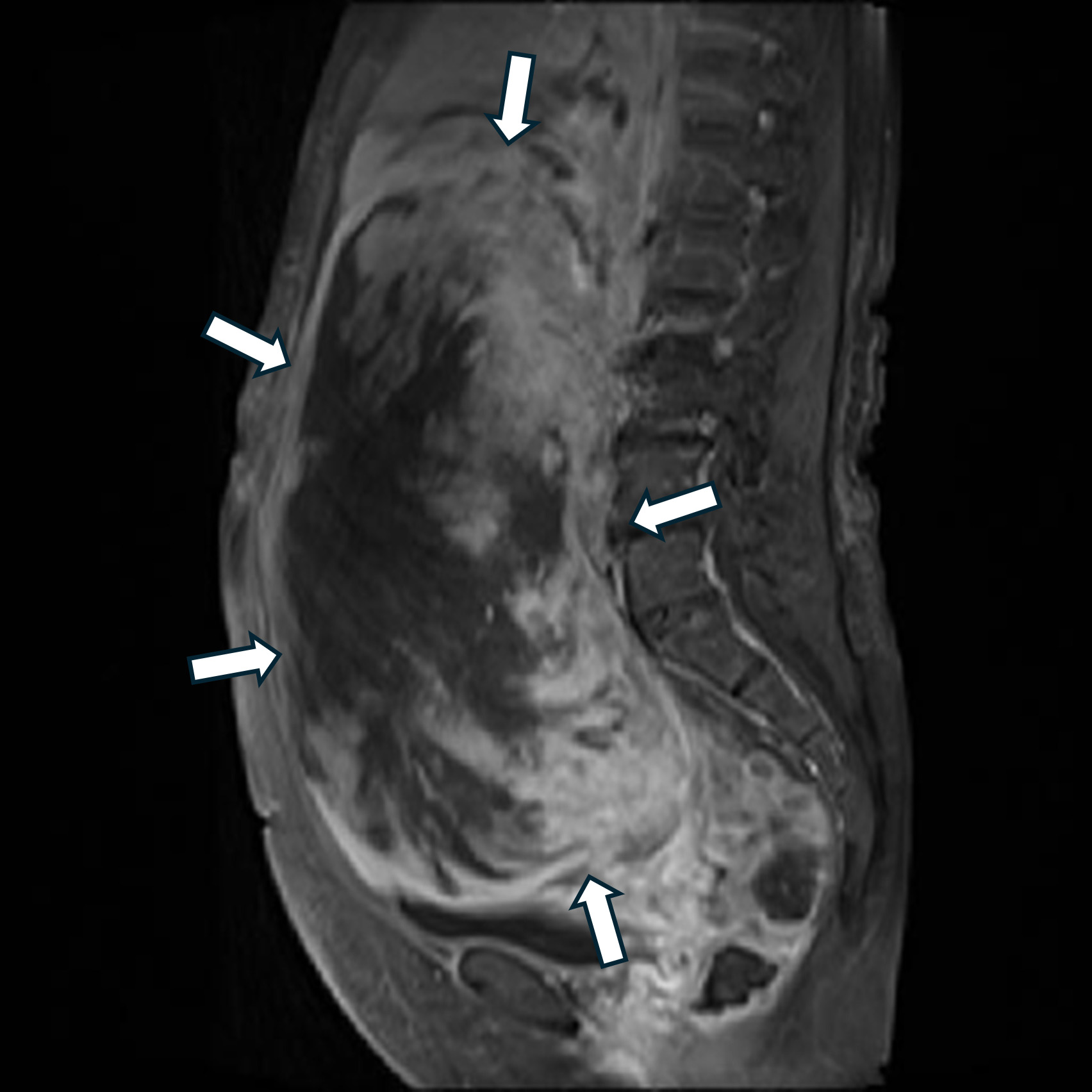 Contrast-enhanced MRI. A large heterogeneous mass extending from
the pouch of Douglas to the upper abdomen (arrows) suggesting a fibroma with
degeneration or a possible fibrosarcoma.