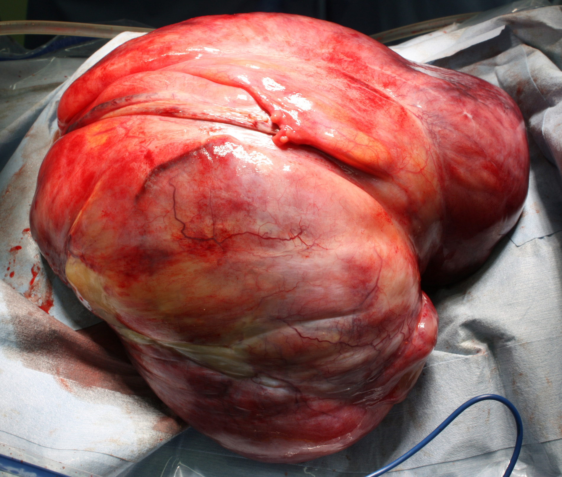 A diagnostic laparotomy revealed a smooth-surfaced tumor without
a capsular rupture or adhesions to surrounding organs.