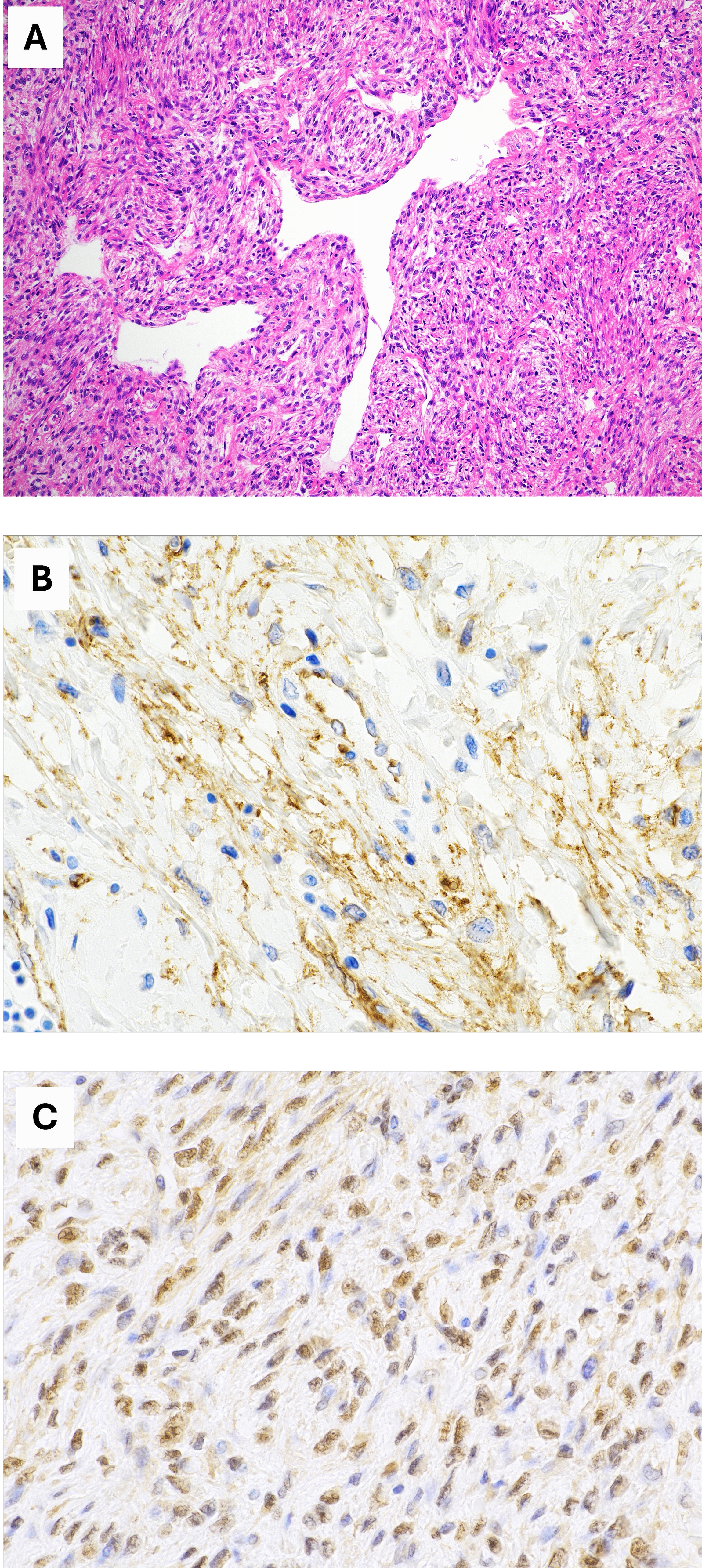 Histopathological findings of the left ovarian tumor. (A)
Histological features of SFT showing haphazardly arranged spindle to ovoid
fibroblast-like tumor cells in a patternless architecture, with variable
cellularity and staghorn-like vasculature (hematoxylin and eosin, original
magnification ×100). (B) Immunohistochemical staining for CD34
demonstrating cytoplasmic positivity in SFT (original magnification
×100). (C) Strong and diffuse nuclear positivity for STAT6 (original
magnification ×400).