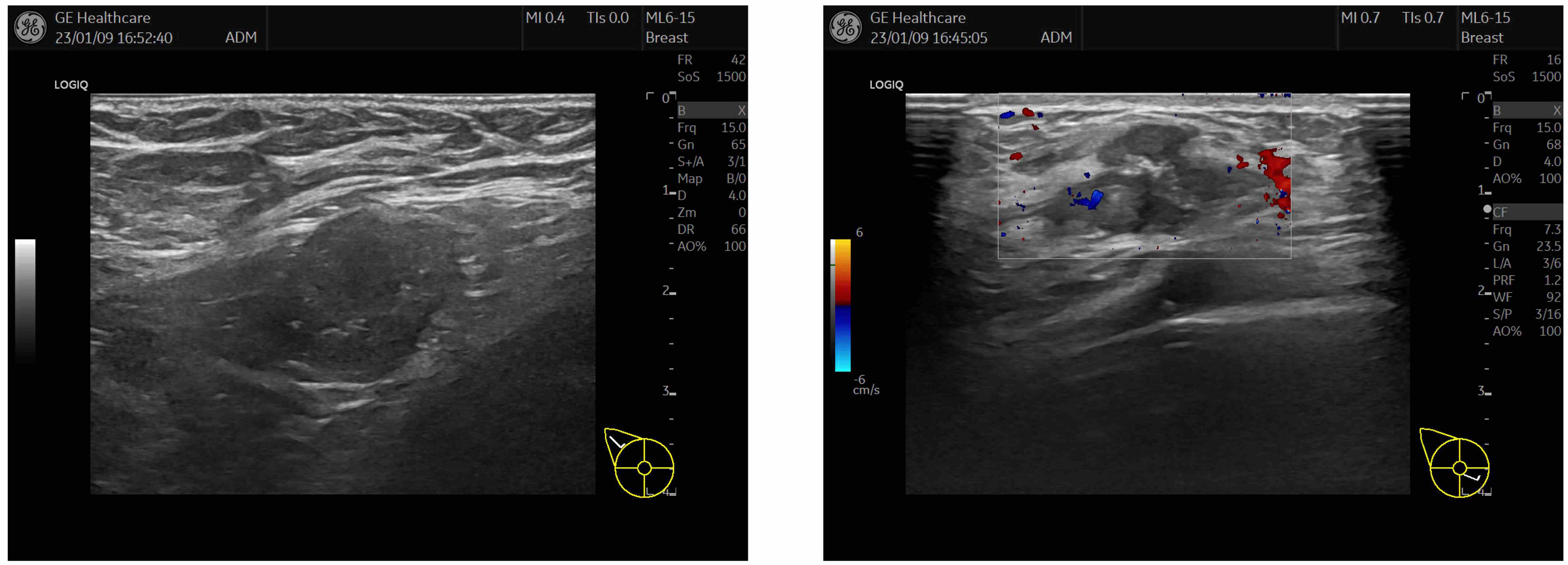 Ultrasound signs of breast cancer.