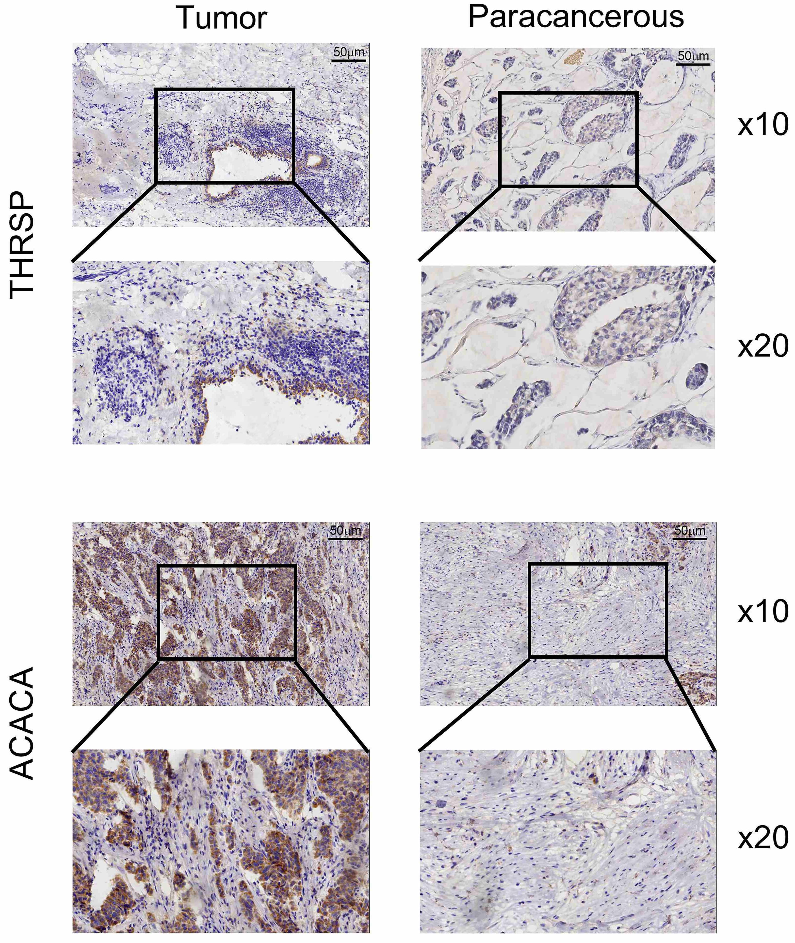 THRSP and ACACA protein expression in breast cancer and
paracancerous tissues detected by immunohistochemical analysis. THRSP, thyroid
hormone response protein Spot14; ACACA, Acetyl CoA carboxylases 1.