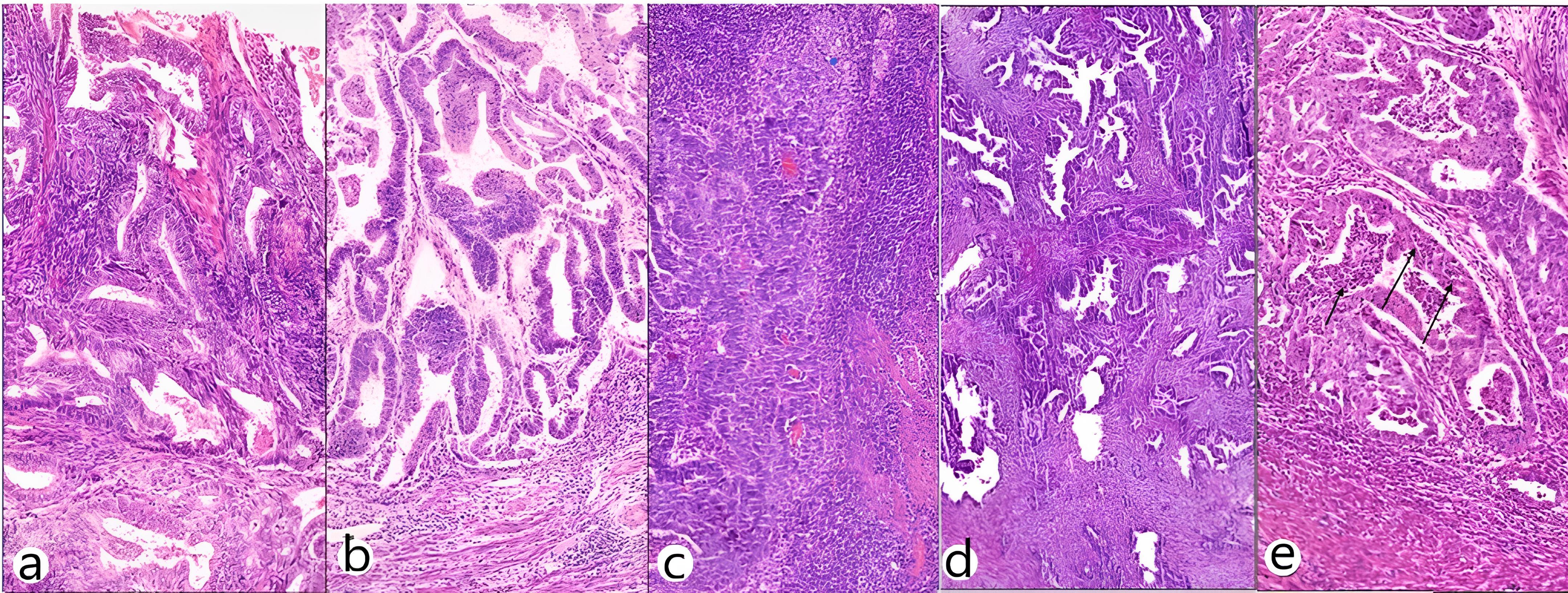 Microscopic view of TIL and TIN scores. (a) TIL score 1 (H&E
×7.52), (b) TIL score 2 (H&E ×8.30), (c) TIL score 3 (H&E
×11.42), (d) TIN score 0 (H&E ×4.40), (e) TIN score 1 (H&E ×4.40). Arrows indicate neutrophil infiltration. H&E: Hematoxylin and
Eosin; TIL: Tumor-infiltrating Lymphocyte; TIN: Tumor-infiltrating Neutrophil.
