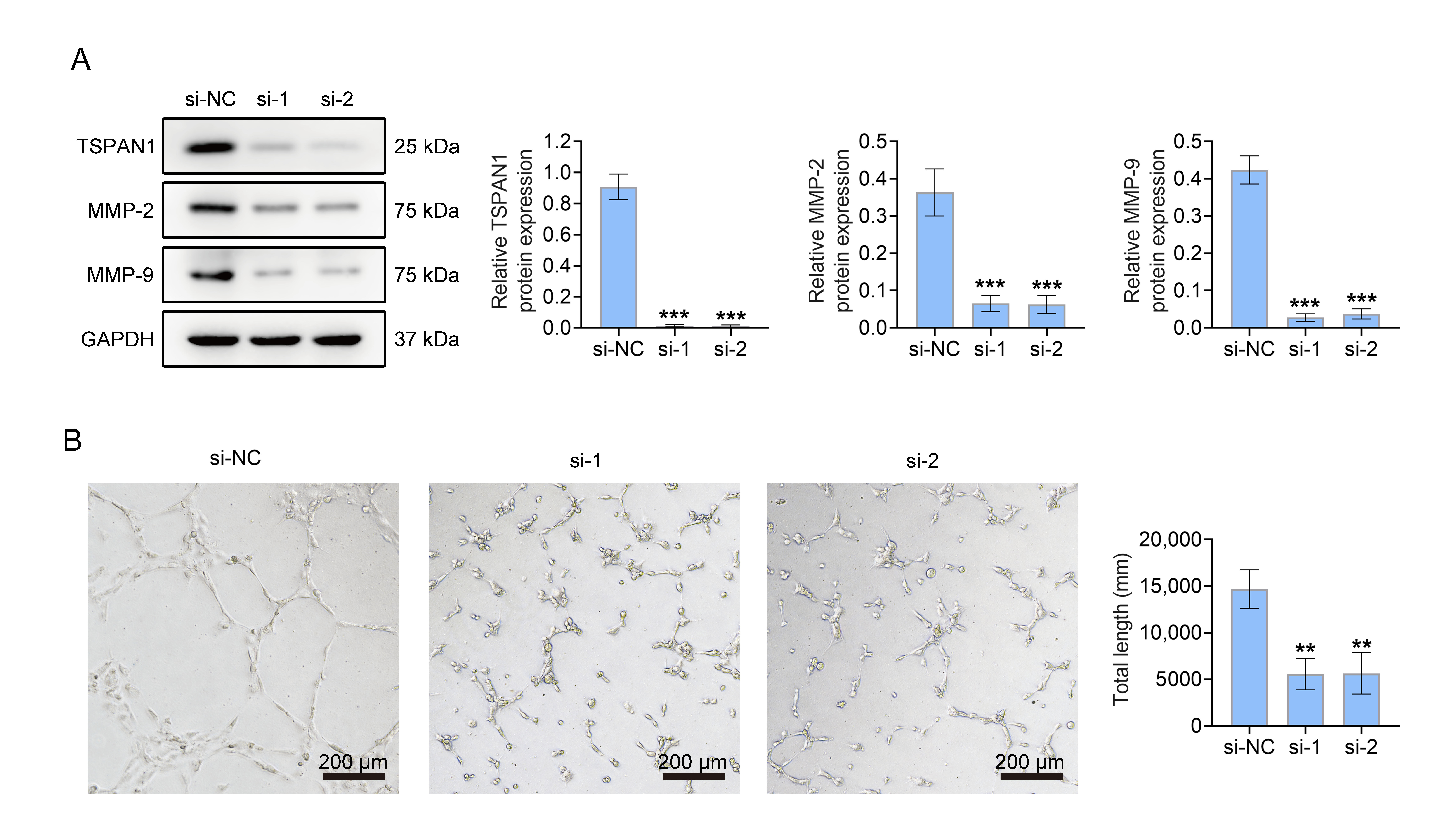 Knockdown of TSPAN1 inhibits angiogenesis in breast cancer
cells. (A) Western blotting to detect the expression of TSPAN1, MMP-2, MMP-9.
(B) Detection of angiogenesis ability of HUVECs. Values are presented as mean
± SD. **p < 0.01 vs. si-NC group; ***p < 0.001 vs. si-NC group. n = 3.
si-NC: siRNA-transfected cells; TSPAN: tetraspanin; MMP: Matrix
Metalloproteinase; GAPDH: Glyceraldehyde-3-phosphate dehydrogenase.