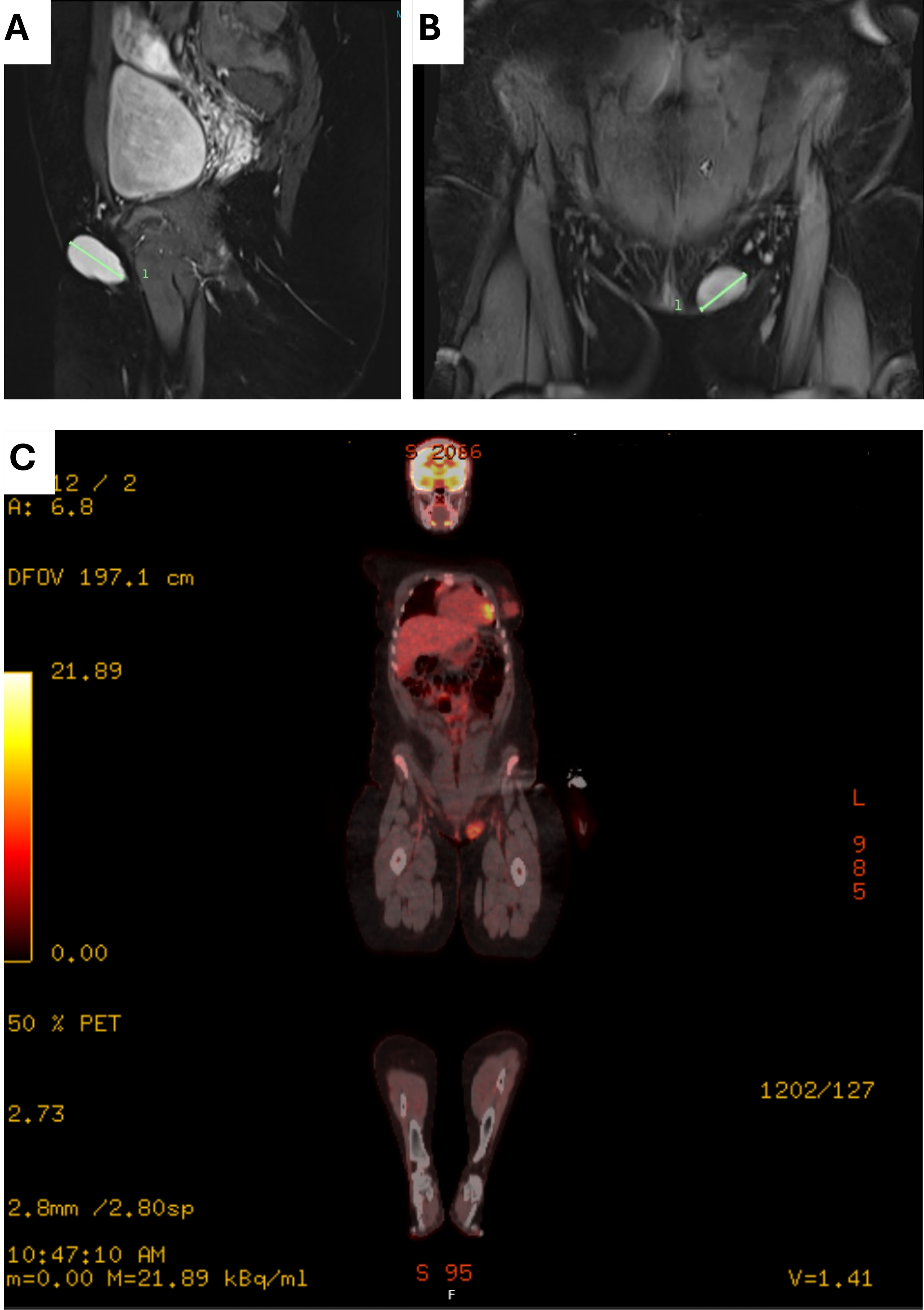 Imaging. (A) Sagittal MRI images that display that the tumour
(marked in green) does not have fascial involvement. (B) Coronal images that
display maximal tumour size (marked in green). (C) PET and CT scan showed metabolically active soft-tissue mass without distant metastasis. DFOV: Display field of view; PET:
Position Emission Tomography.