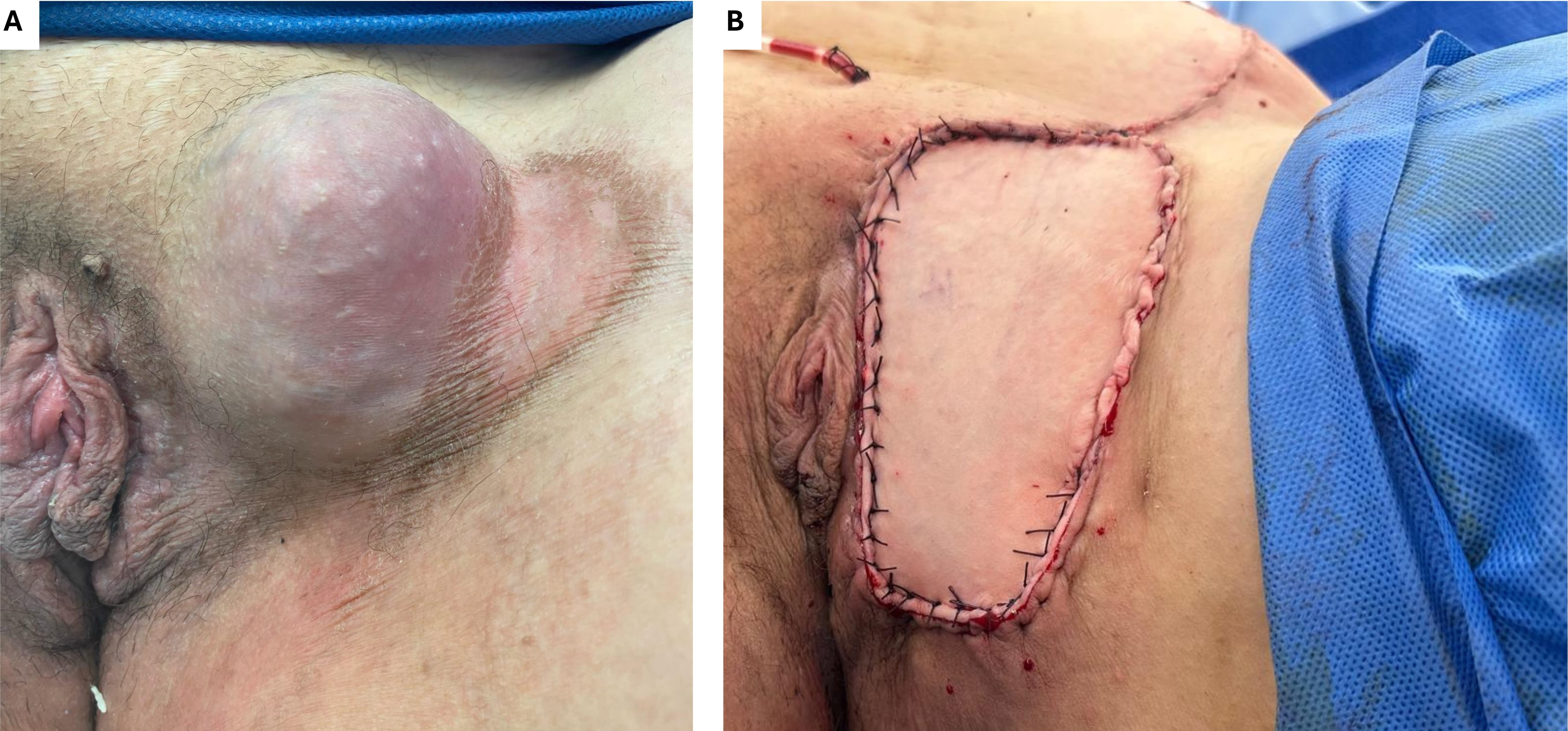 Intra-operative images. (A) Pre-operative image displaying the
8 cm left vulval mass adjacent to the clitoris and pubic symphysis superiorly. It
was 1 cm adjacent to the border of the introitus and 1 cm medial to medial border
of the adductor longus laterally. (B) Post-operative image after completion of
radical local excision, mesh reconstruction of rectus sheath and left inguinal
ligaments and local flap reconstruction with a superficial circumflex iliac
perforator (SCIP) flap in a joint procedure with the Plastic Surgery team.