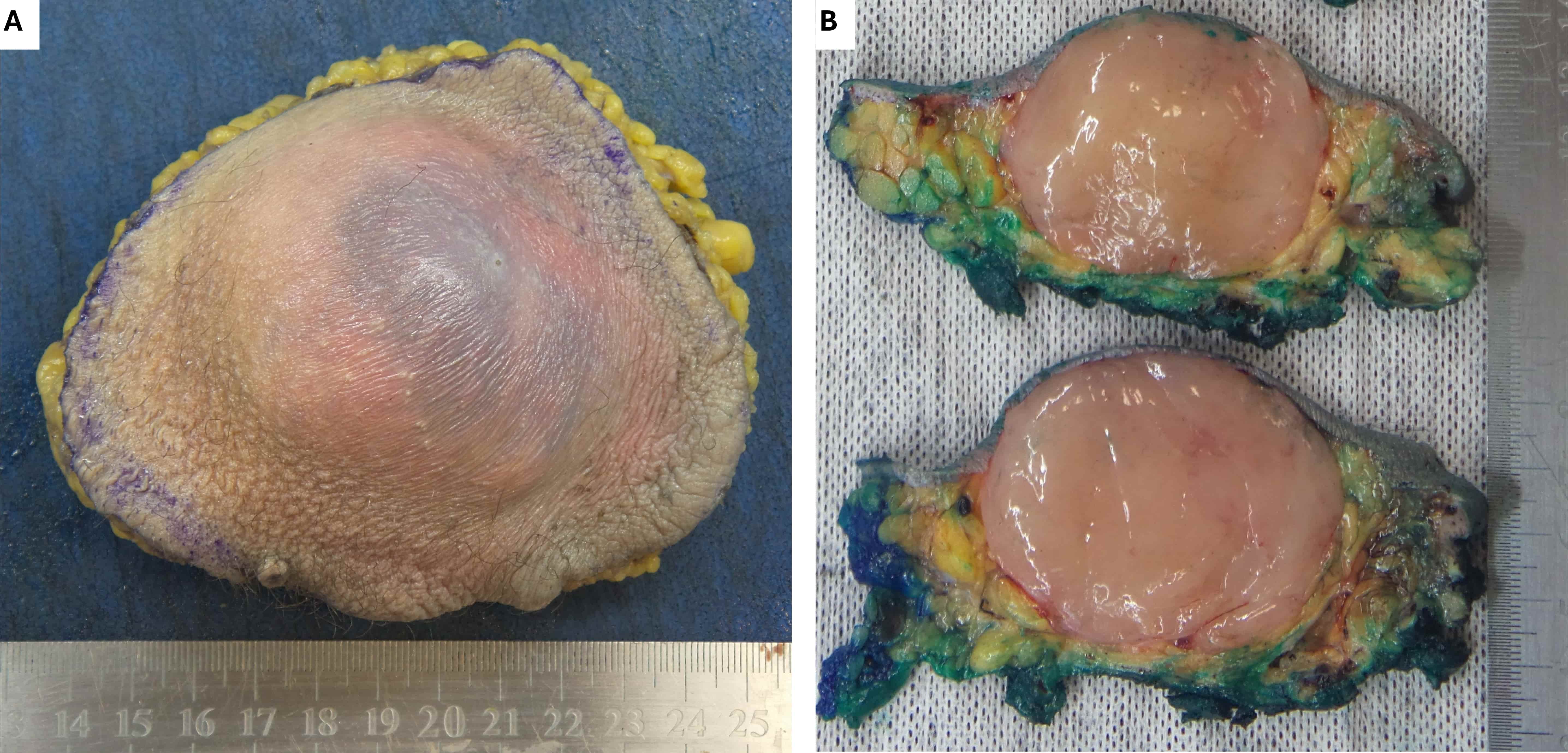 Macroscopic features. (A) Macroscopically the tumour consisted
of an expansile, exophytic mass. (B) Its cut surface showed a well defined,
glistening, “myxoid” lesion which lacked macroscopic evidence of infiltrative
growth.
