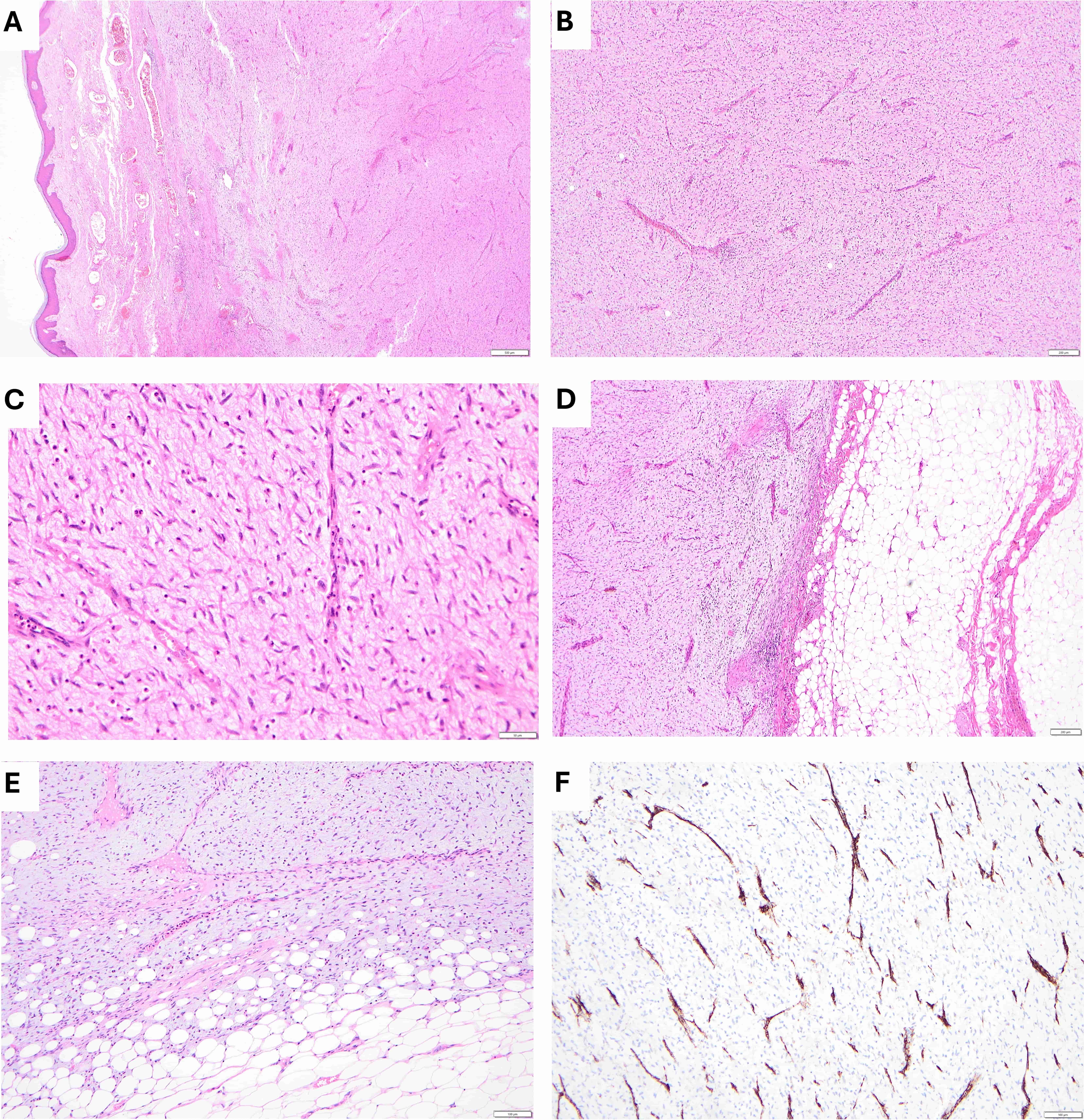 Microscopic features. (A) Microscopically the tumour consisted
of a spindle cell lesion with prominent myxoid stroma, seated in the dermis and
subcutis. Scale = 500 μm. (B) It showed even cellularity throughout, with bland
spindle cells, scattered mitoses and scattered eosinophils without sarcomatous
morphology. Scale = 200 μm. (C) Demonstrates the bland spindle cells and scattered
mitoses. Scale = 100 μm. (D) It was largely well defined with a circumscribed
border. Scale = 200 μm. (E) Focal areas showed infiltrative growth into fat with
some “honeycombing” reminiscent of conventional DFSP. Scale = 100 μm. (F) CD34
was uniformly negative, but highlights the rich thin-walled vasculature present
throughout the lesion. Scale = 100 μm.