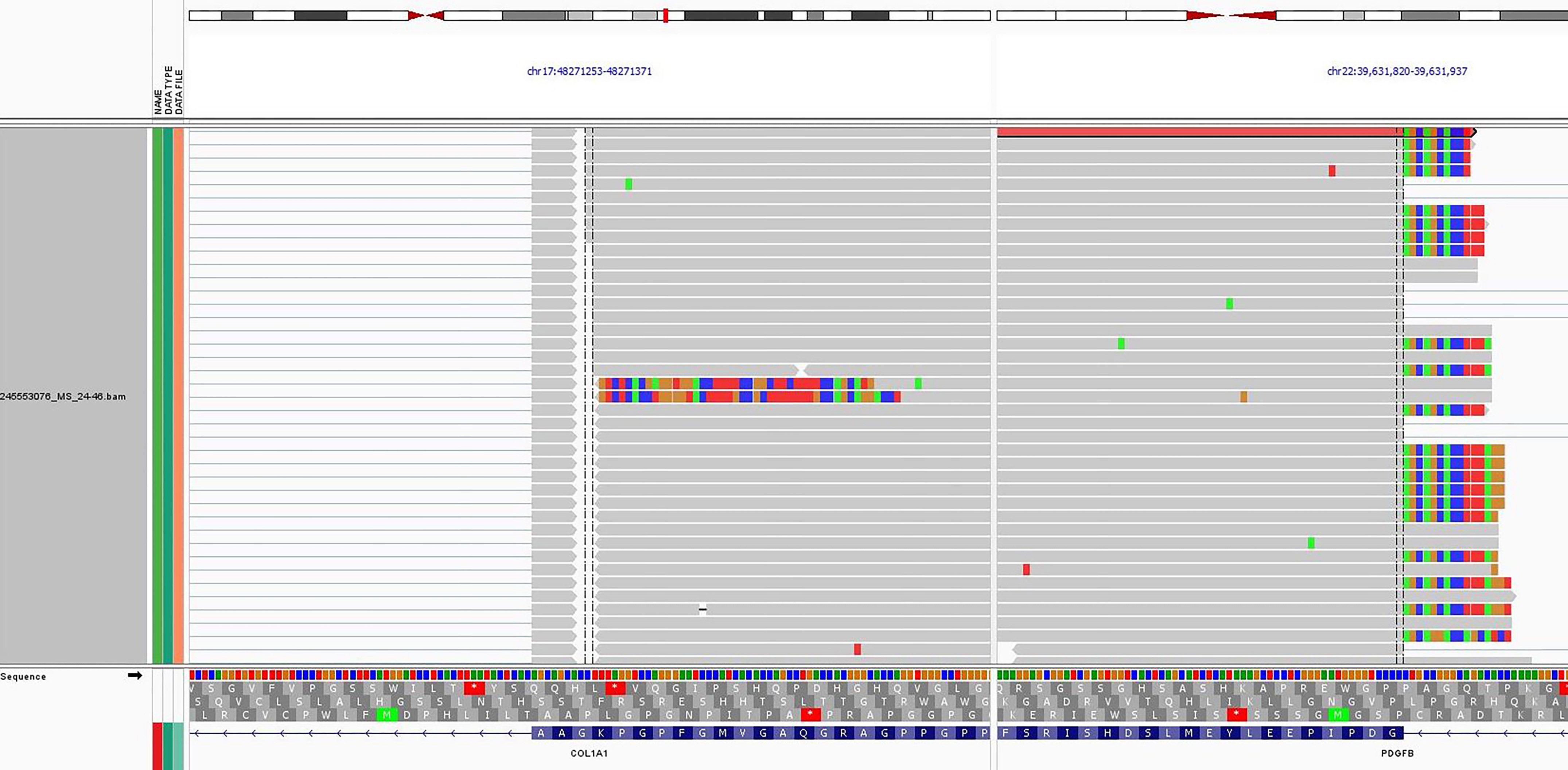 RNA Sequencing. 507-gene RNA fusion panel (Illumina, Inc, CA,
USA) displaying COL1A1::PDGFB fusion between exon 25 of COL1A1
and exon 2 of PDGFRB which was key in the diagnosis of DFSP.