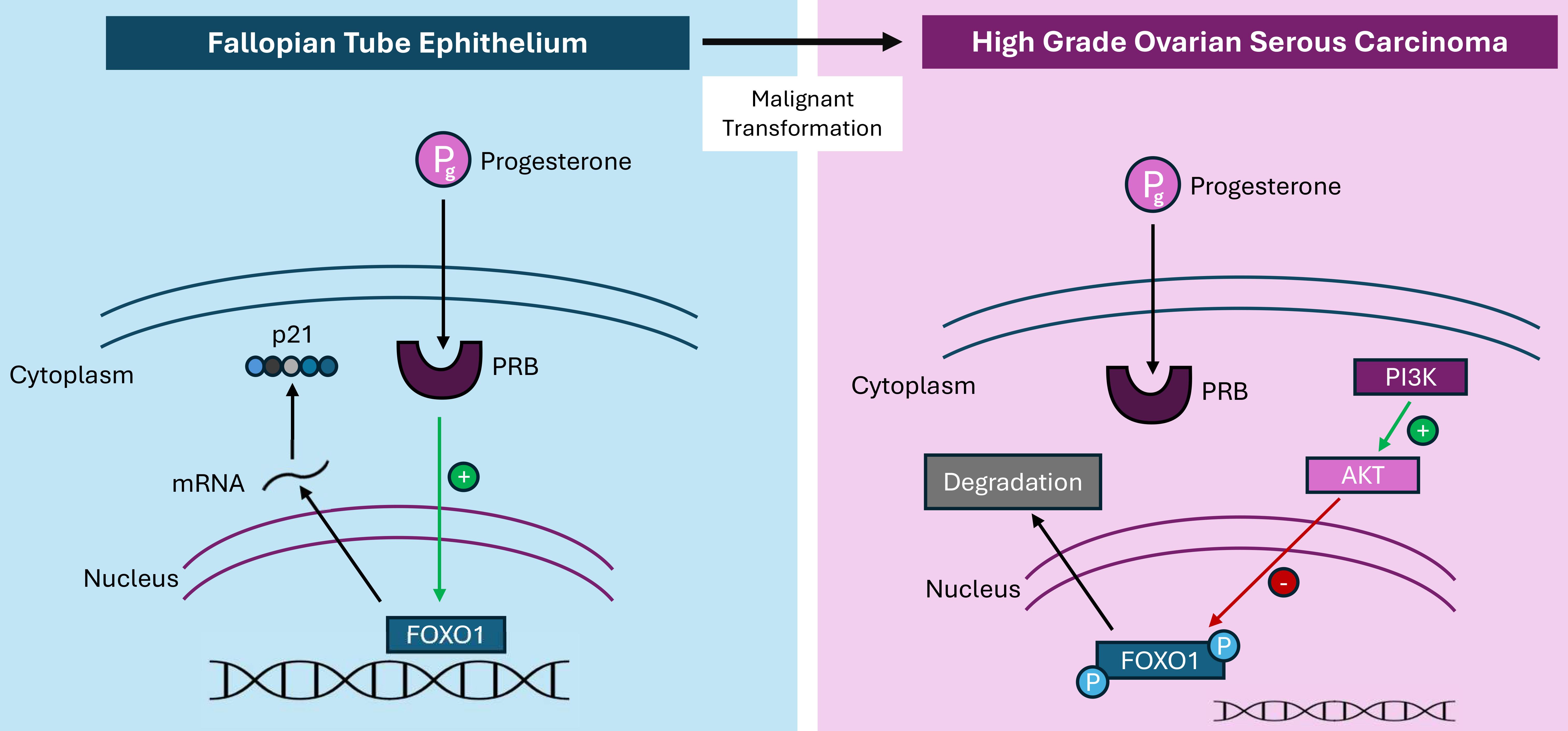 Schematic representation of how, during the malignant 
transformation of fallopian tube epithelium into high-grade serous ovarian 
carcinoma (HGSOC), aberrant activation of the PI3K/AKT signalling pathway leads 
to phosphorylation and nuclear exclusion of FOXO1, impairing its tumour 
suppressive activity. In normal epithelium, progesterone binds to the 
progesterone receptor isoform B (PR-B), activating transcription of genes such as 
p21, which inhibit cell proliferation via FOXO1 nuclear localization. PRB, 
progesterone receptor isoform B; FOXO1, transcription factor FOXO1; PI3K, 
phosphoinositide 3-kinase; AKT, protein kinase B; p21, cyclin-dependent kinase 
inhibitor 1A. Figure created by the authors.