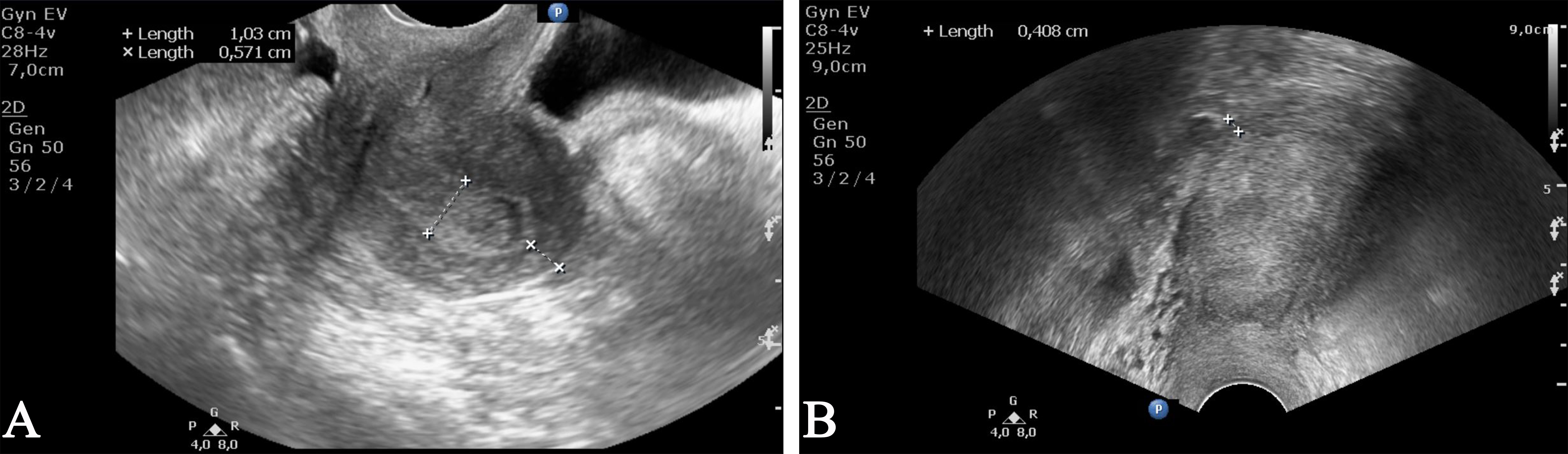 Examples of subjectively assessed (A) superficial and (B) deep
myometrial invasion with transvaginal ultrasound.