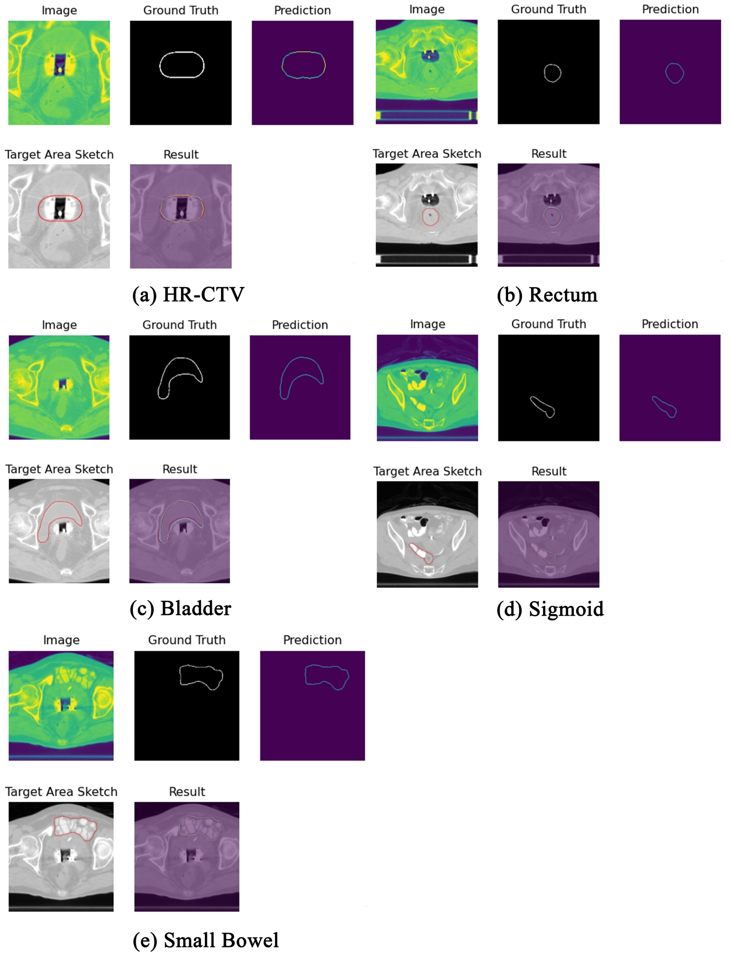 Effects of U-Net automatic delineation for HR-CTVs and OARs. 
(a) HR-CTV. (b) Rectum. (c) Bladder. (d) Sigmoid. (e) Small Bowel. Image: This 
refers to the result of contrast-adaptive histogram equalization enhancement 
applied to the image. Ground truth: This is the contour drawn by the physician. 
Prediction: This represents the contour predicted by the network. Target area 
sketch: This is the physician’s initial contour on the image. Result: This is a 
comparison between the predicted contour and the physician’s contour. In the 
resulting images, the red lines indicate the manually drawn contours of the 
HR-CTV and OARs (organs at risk), whereas the blue lines represent the contours 
automatically delineated by the model for the HR-CTV and OARs. HR-CTV: high-risk 
clinical target volumes.