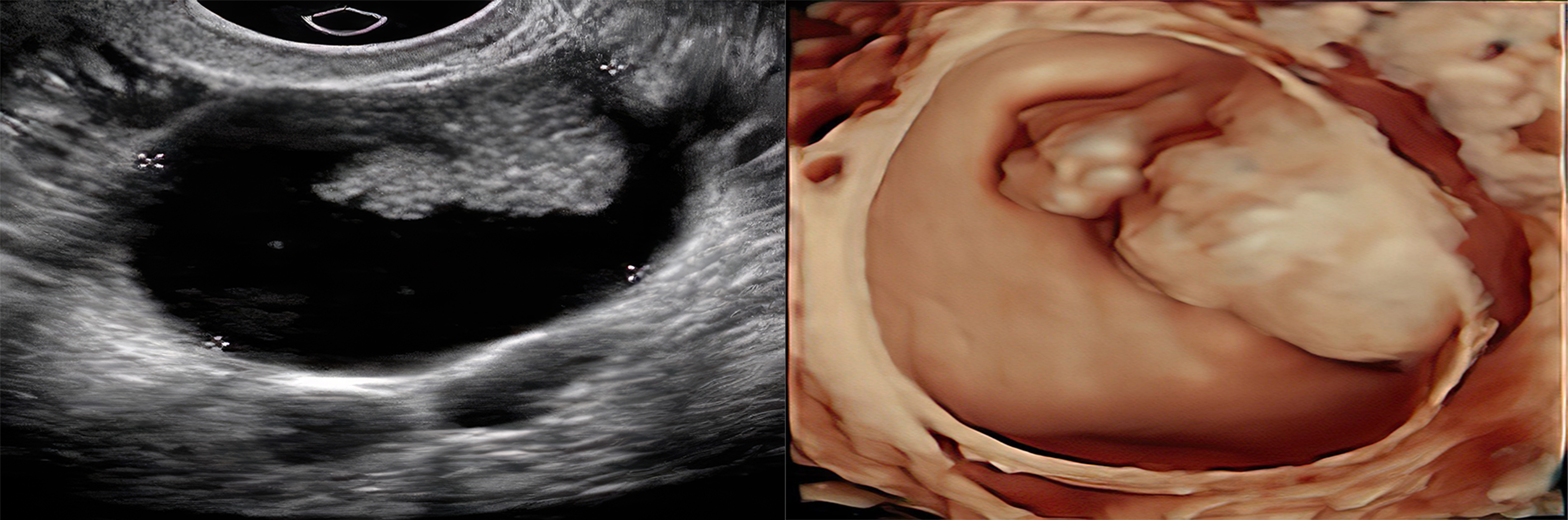 Ultrasonographic images of adnexal mass.