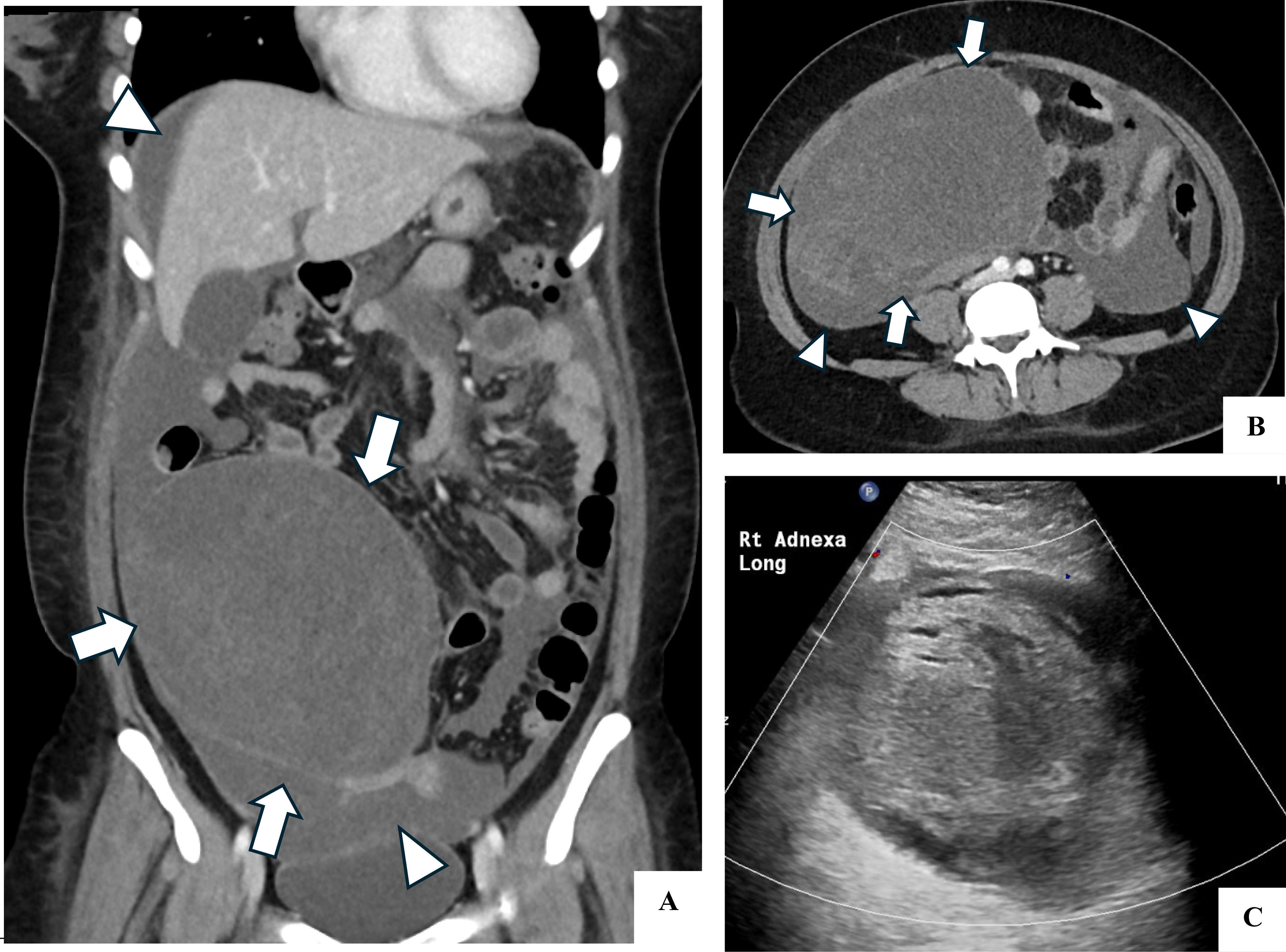 CT and ultrasound images of the pelvic mass. (A,B) CT
contrast-enhanced coronal (A) and axial (B) planes demonstrating the large right
pelvic mass (white arrows) which is predominantly cystic, with internal solid
enhancing component. The mass had rapidly increased to 16 × 11
× 14 cm from 13 × 9 × 10 cm from 8 days prior. There
is ascites (white arrow heads). (C) Pelvic ultrasound showing a hyperechoic mass
that is avascular. A normal right ovary was not identified.