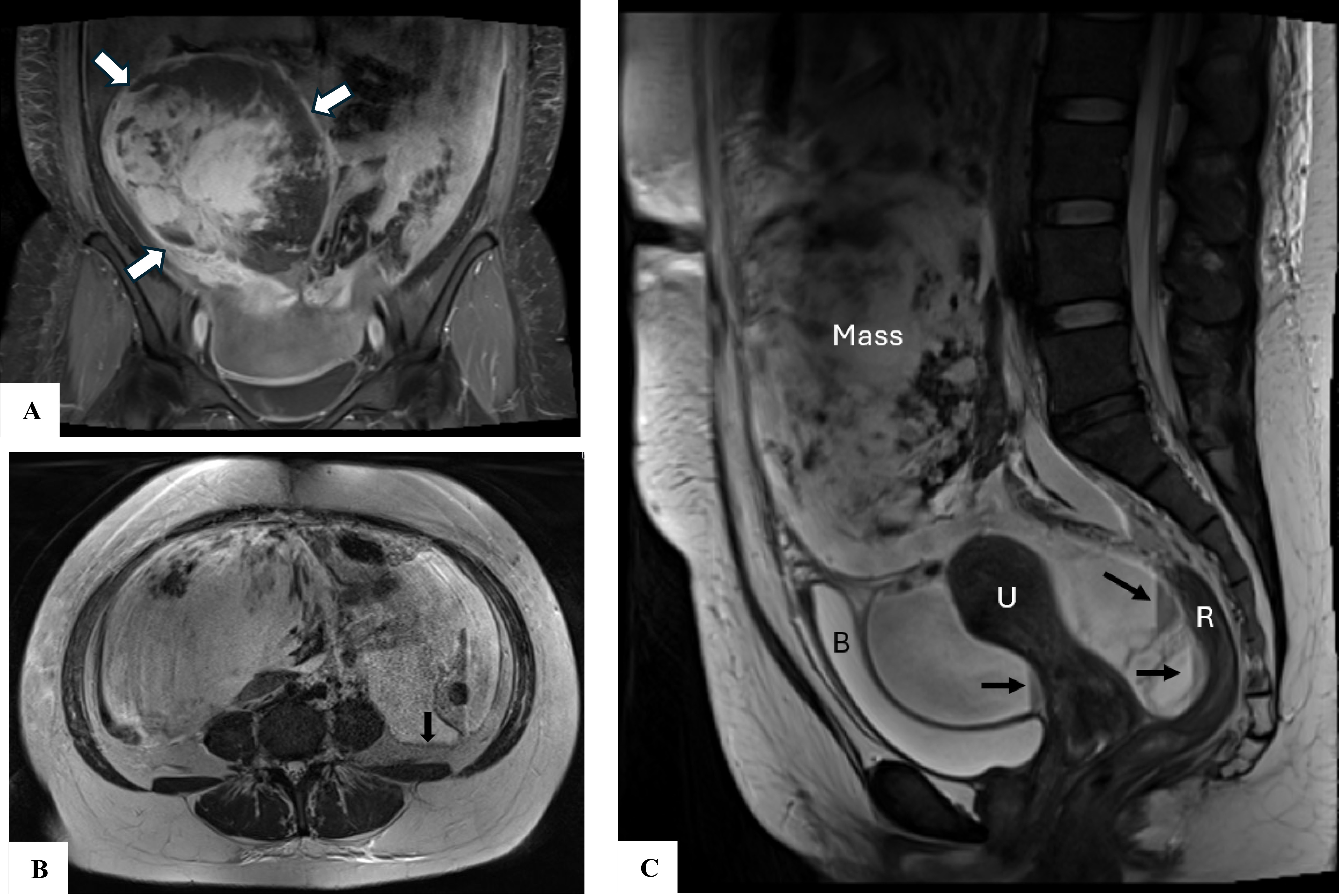 MRI images of the pelvic mass. (A) MRI coronal
contrast-enhanced T1 fat suppressed sequence demonstrating heterogeneous
enhancement of the solid/cystic right pelvic mass (white arrows). (B,C) MRI
axial and sagittal T2 sequences. There is loculated ascites, which is complex
with thick septations and dependent fluid-fluid levels in the vesicouterine and
rectouterine pouches, as well as in the left paracolic gutter (black arrows). The
signal is in keeping with layering haemorrhage. U (uterus), R (rectum), B
(bladder), Mass (right pelvic mass).