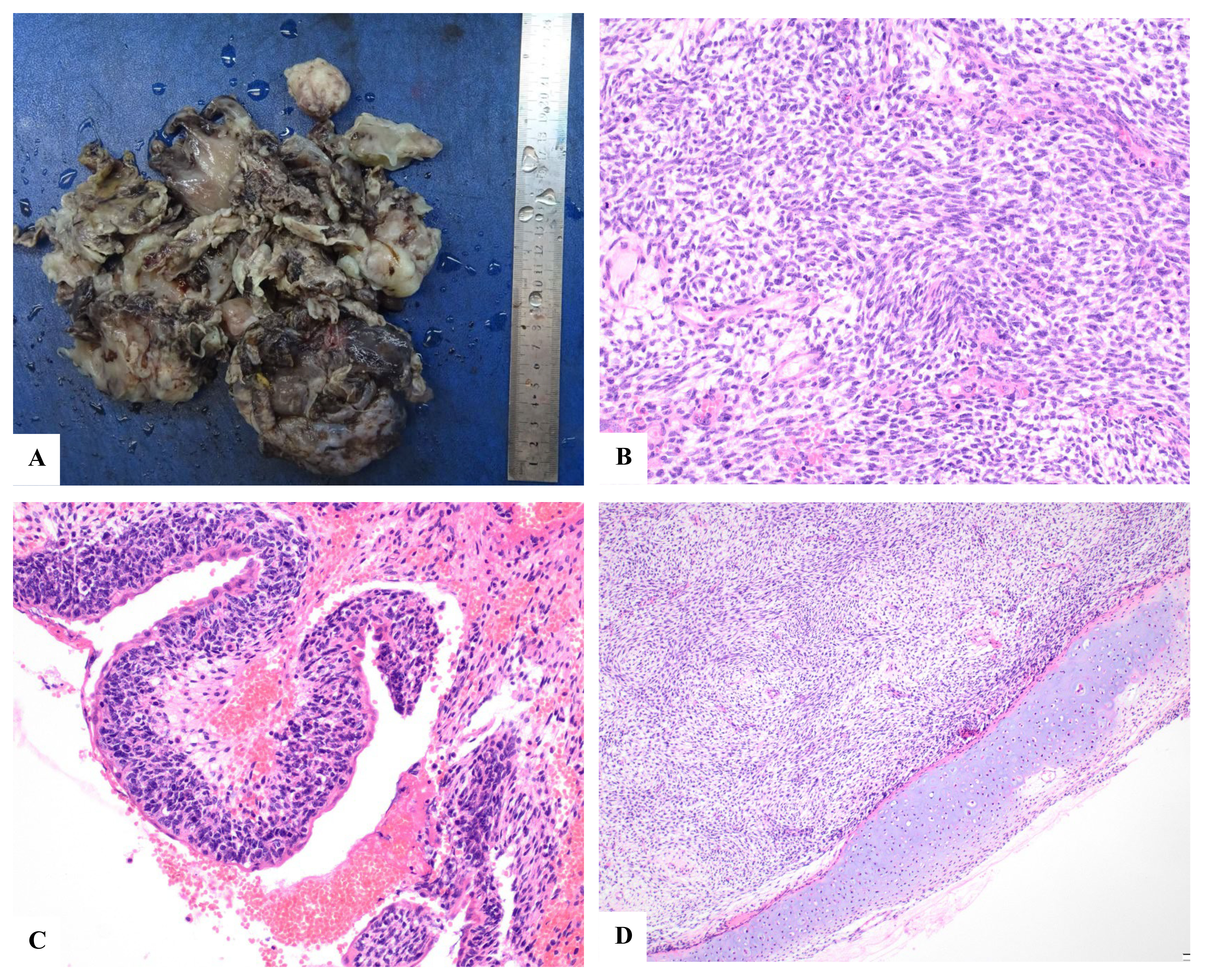 Pathology images. (A) Macroscopic image of specimen removed at
the time of surgery. (B) Malignant spindle cell neoplasm, ×100
magnification. (C) Tumour cambium layer, ×100 magnification. (D)
Heterologous cartilage, ×40 magnification.