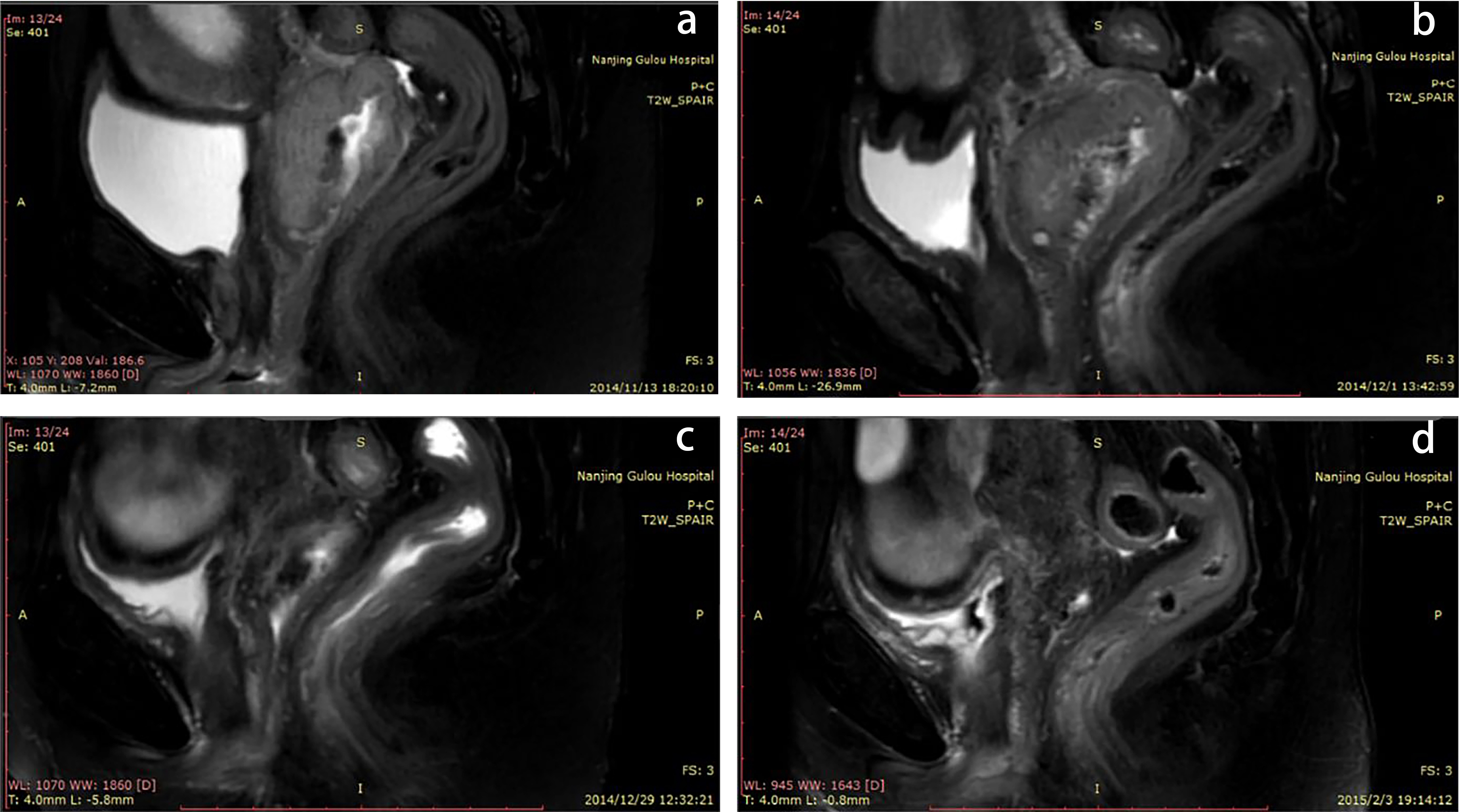 Changes in rectal MRI images of a cervical cancer patient
undergoing radiotherapy at different stages. (a) Rectal scanning image of
patients before radiotherapy in T2 SPAIR sequence; (b) Rectal scanning image at 2
weeks of the radiotherapy, demonstrating increased thickness compared to that
before radiotherapy; (c) Significant rectal edema at the end of the external
irradiation, with the rectal wall thickness reached the highest value in the
course of the disease; (d) Rectal wall thinner than before after the end of
brachytherapy. MRI: Magnetic Resonance Imaging; T2: Tissue 2; SPAIR: Spectral
Attenuated Inversion Recovery.