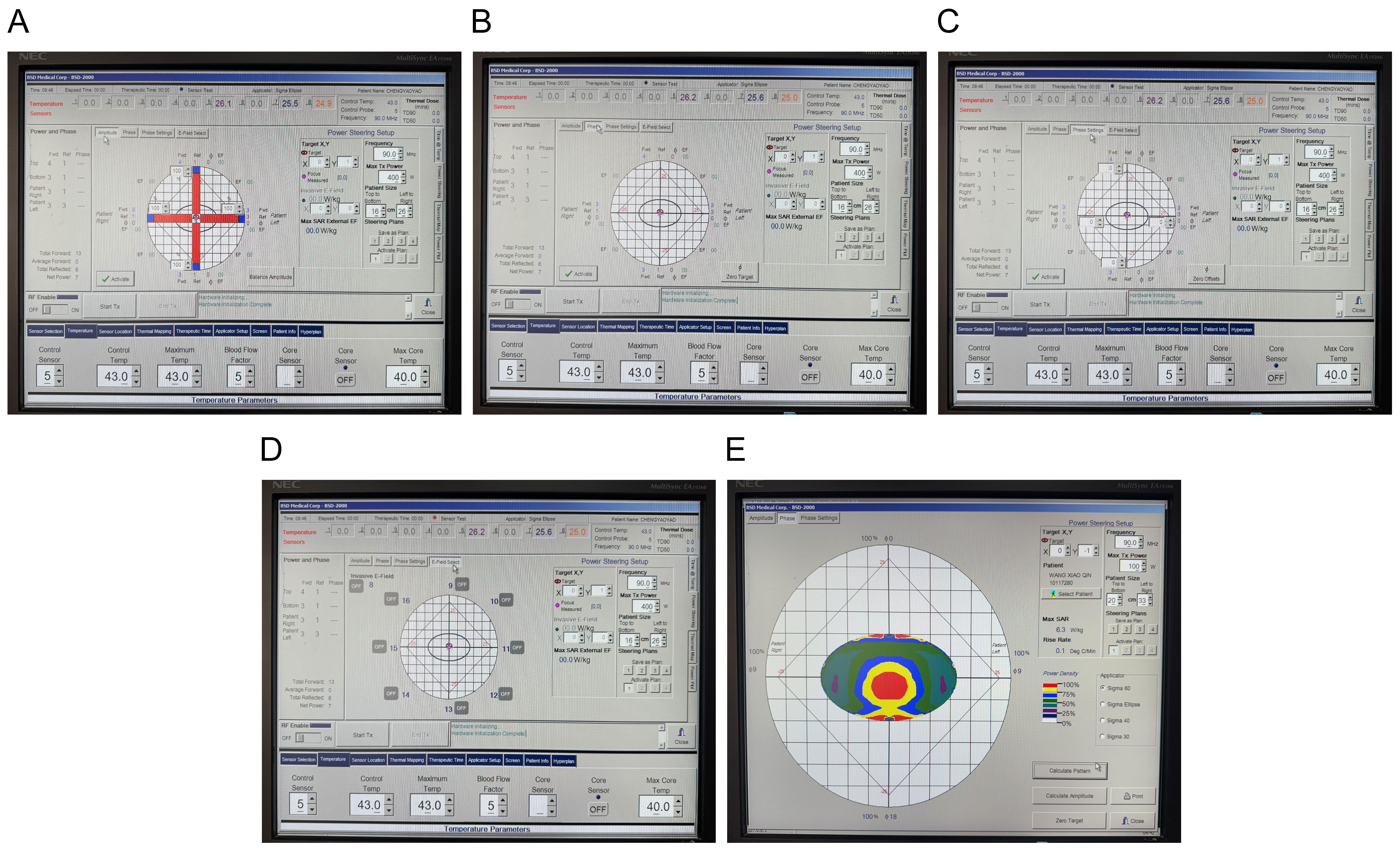 BSD-2000 hyperthermia system. (A–D) Real-time treatment control
interface. (E) Computer-simulated thermal field distribution.