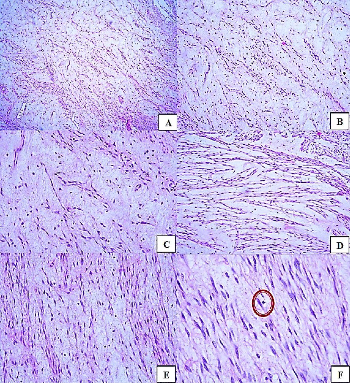 Hematoxylin and eosin (HE) staining of myxoid smooth muscle 
tumor of uncertain malignant potential (STUMP) in different power fields: A 
(×50), B (×100), C–E (×200), F (×400). Tumor 
shows fascicular pattern and prominentn myxoid differentiation (more than 50% of 
entire tumor mass). There was no necrosis, or atypia. Mitosis were rare, 1/10 HPF 
(red circle in F).