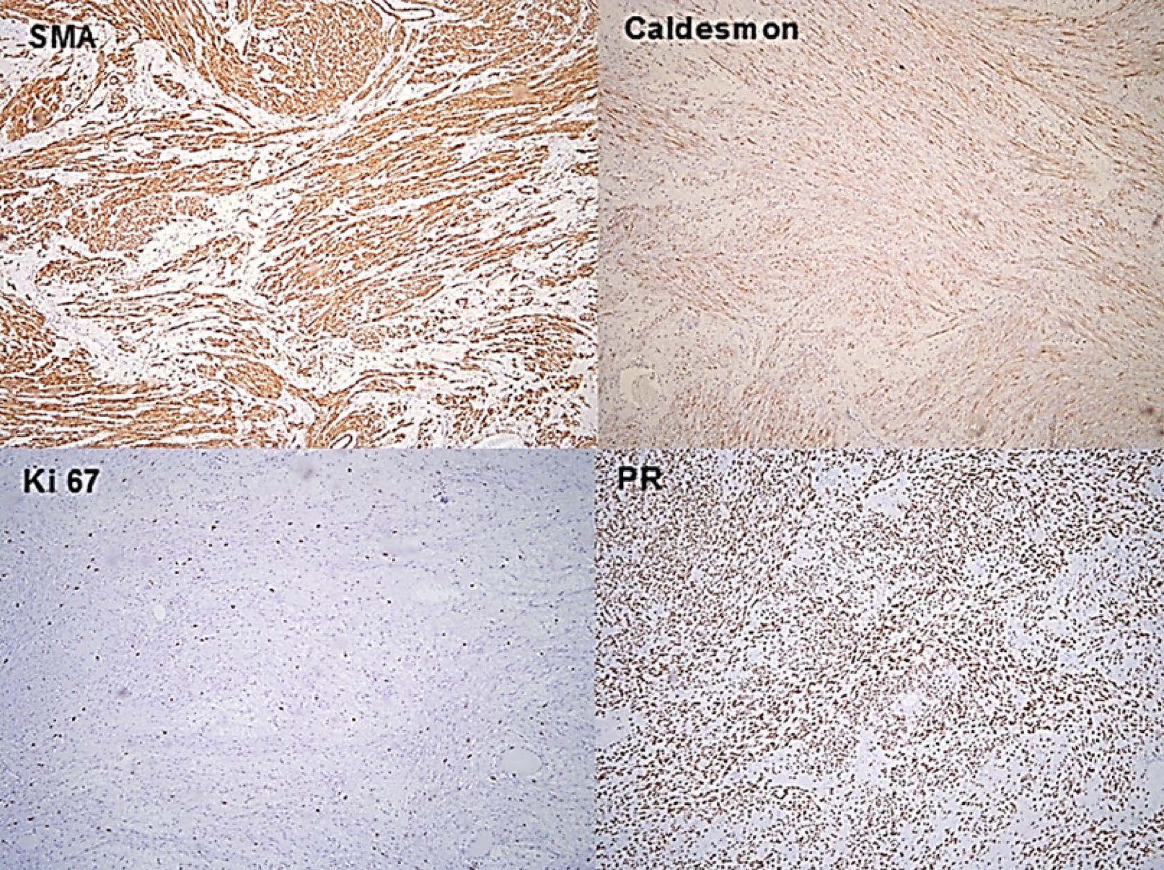 Imunohistocehmical staining (×100) confirmed smooth 
muscle differentiation (smooth muscle antigen (SMA), Caldesmon), retained 
progesterone receptor (PR) and low marker of proliferation Ki-67 (5%), 
which imply to mostly indolent behavior of considering tumor.