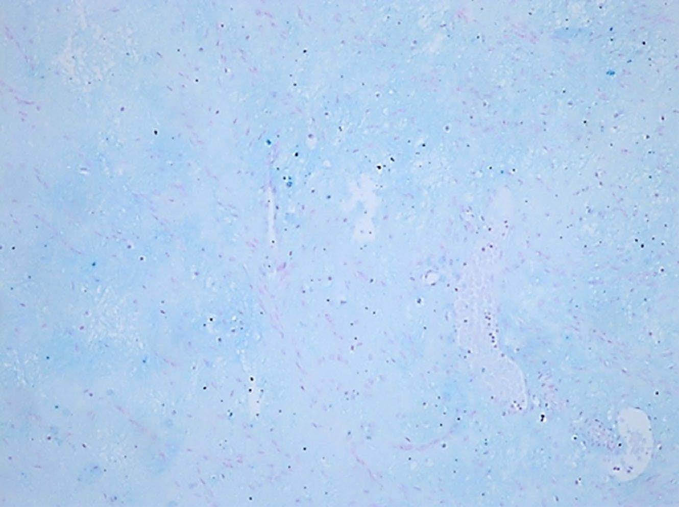 Histochemical staining with Alcian Blue 
(×400) confirmed presence of myxoid substance, significant in 
differentiation from hydrops degeneration in conventional leiomyoma.