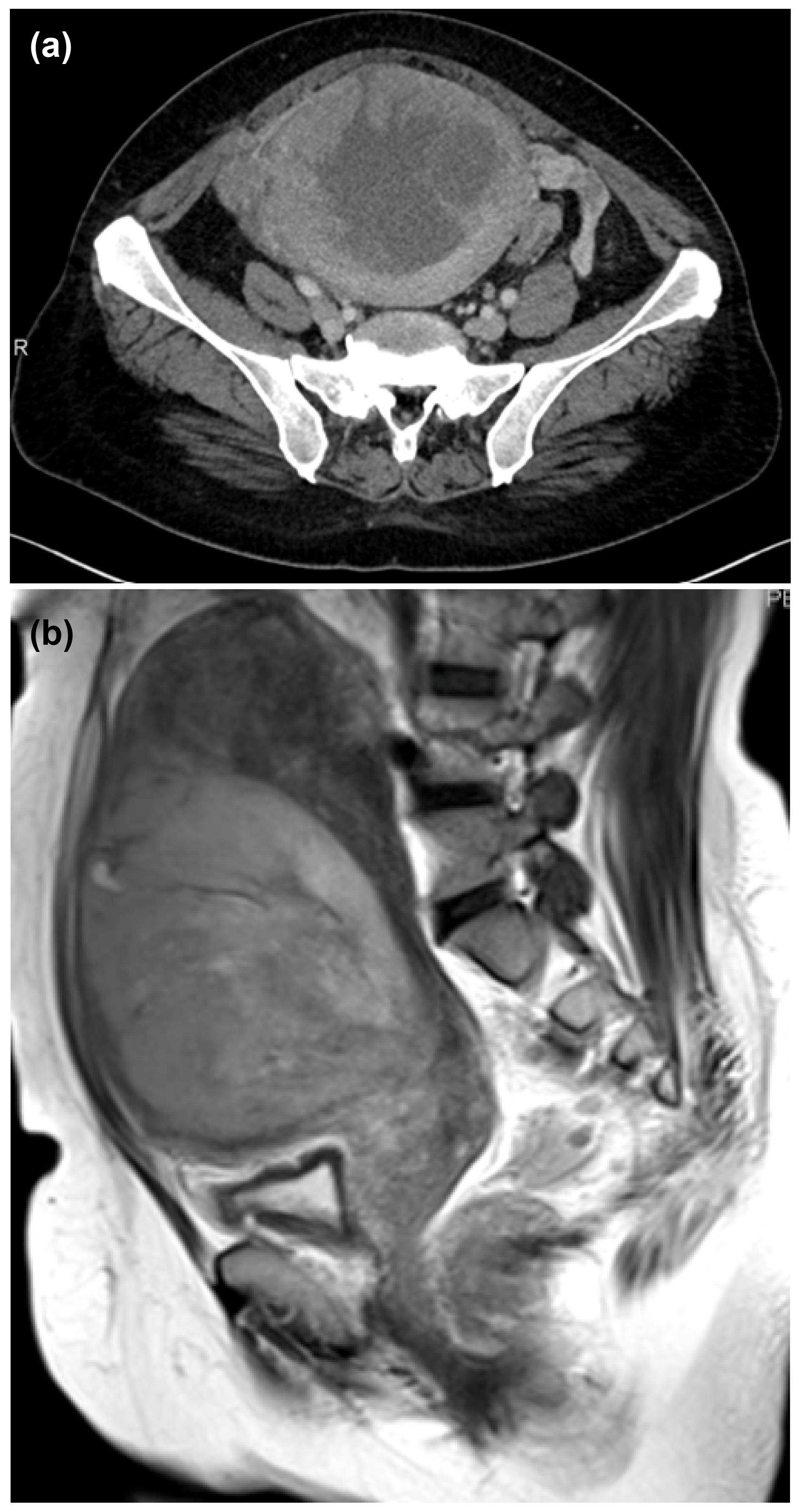 Preoperative imaging studies. (a) Contrast-enhanced computed
tomography images (on admission). The mass centered on the anterior uterine wall
contains high-density areas suggestive of hemorrhage and is associated with
increased attenuation in the surrounding adipose tissue. However, no definitive
findings indicate tumor rupture. (b) T2-weighted magnetic resonance imaging. A
110-mm mass centered on the anterior uterine wall exhibits intermediate signal
intensity and extends downward in a drooping manner, reaching the endocervical
canal.