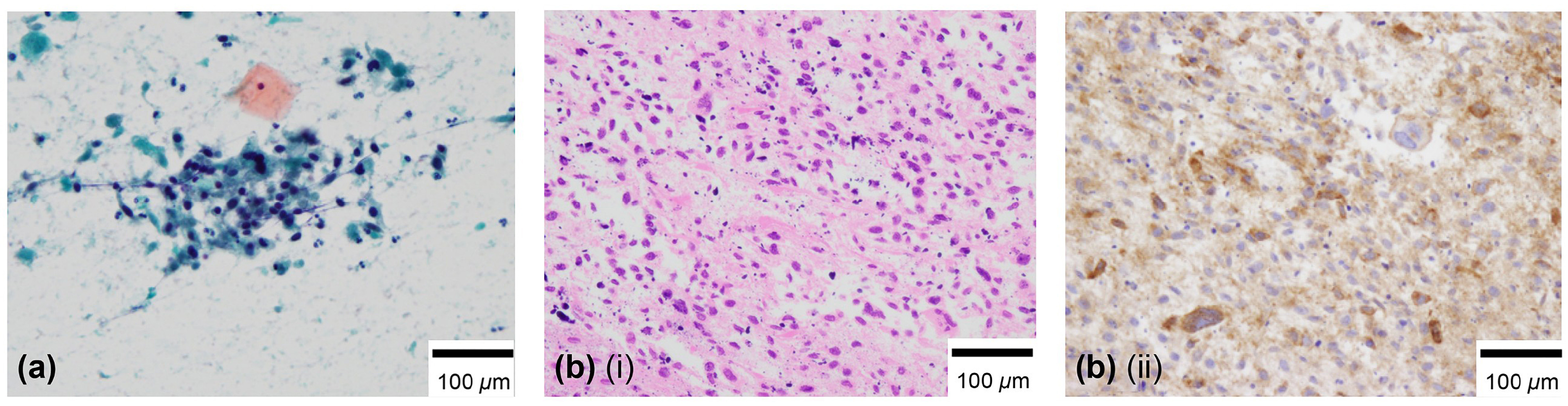 Diagnostic cytology and histopathology. (a) Cytological smear
(Papanicolaou staining). Degenerated cells with a high nuclear-to-cytoplasmic
ratio are scattered, showing nuclear irregularity and increased chromatin levels.
(b) Histological biopsy results. (i) Hematoxylin and eosin staining
(×400): Degenerated cells with nuclear enlargement are observed. (ii)
CD10 staining: Positive.