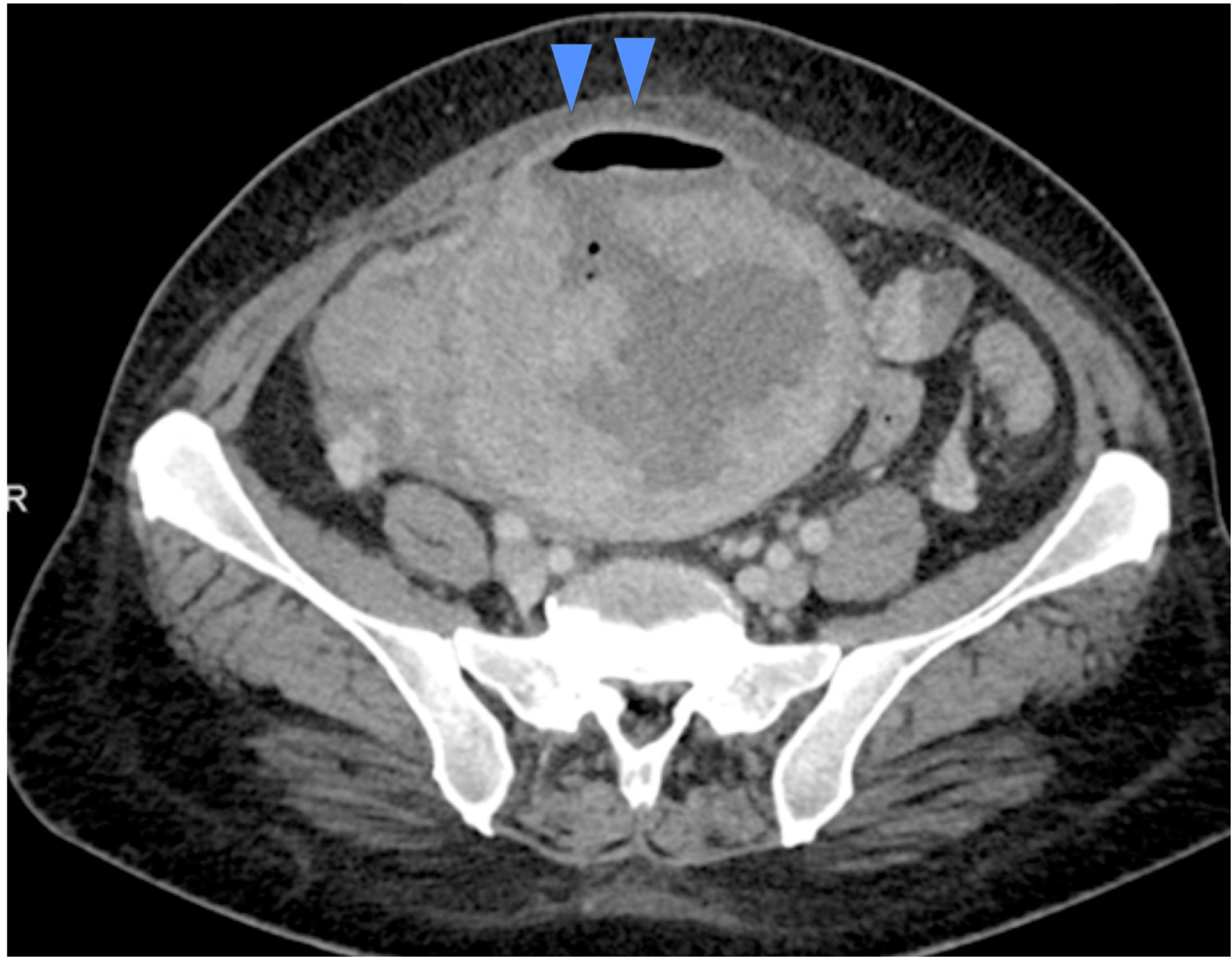 Contrast-enhanced computed tomography image (during
hospitalization). Disruption of the contour between the tumor and the uterine
myometrium is noted on the cranial side of the mass (blue arrowheads). The
rupture site is covered with omental tissue, and fluid collection and free air
are observed.
