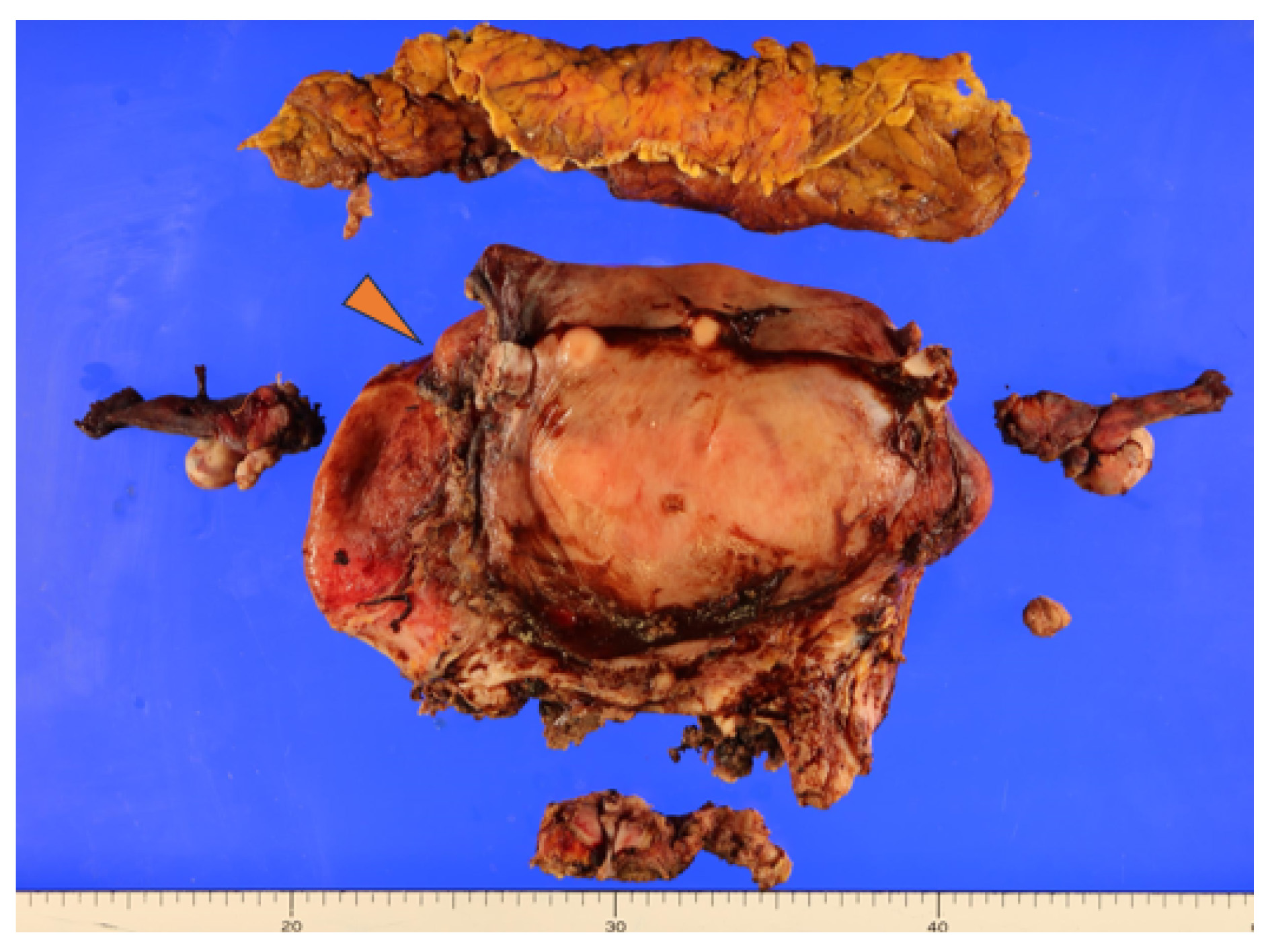 Macroscopic findings. A yellowish-white tumor measuring
approximately 80 mm extends from the uterine body to the fundus, with areas of
hemorrhage and necrosis. A clear perforation is noted in the anterior uterine
wall.