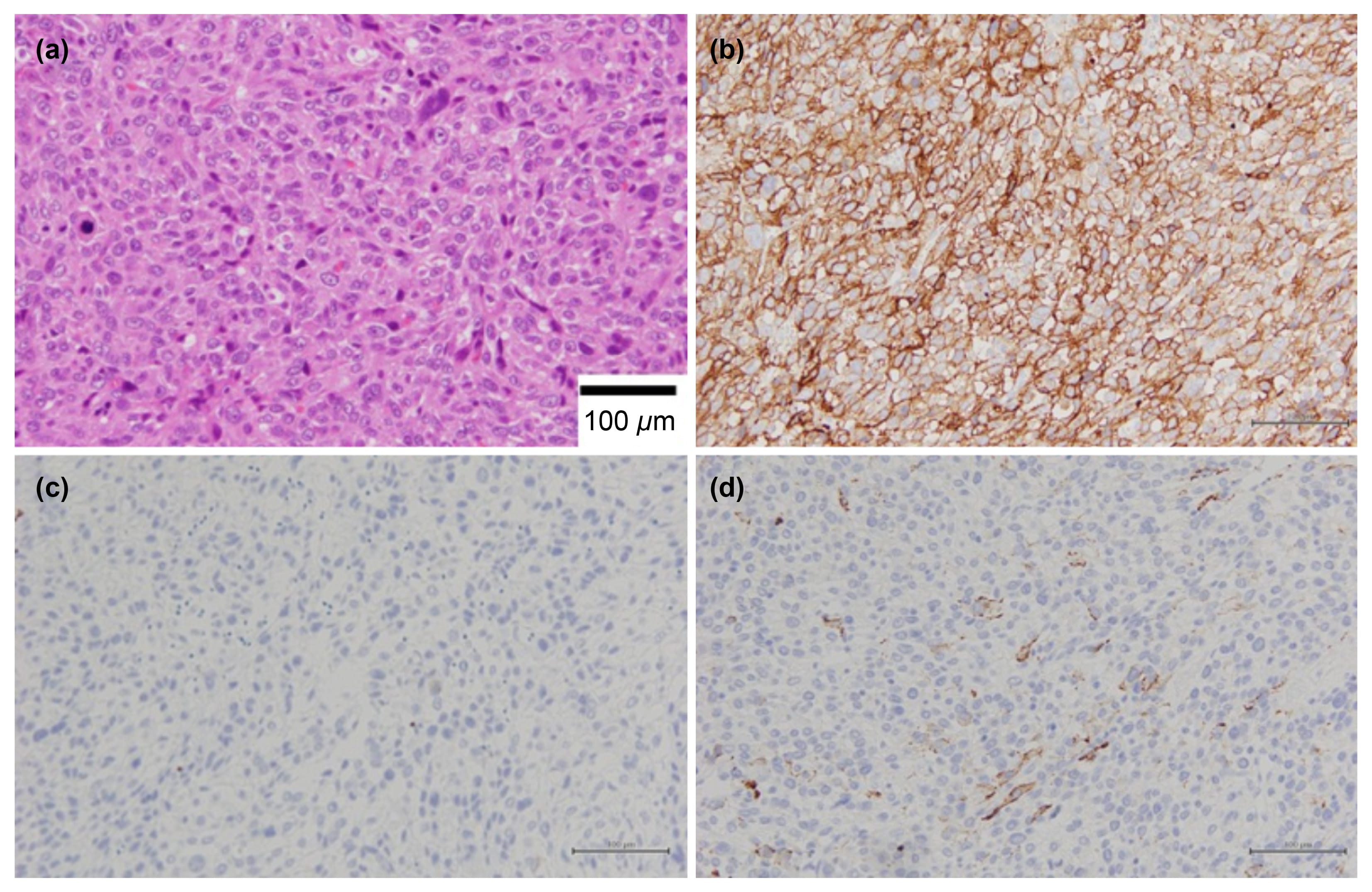 Histology of the epithelioid leiomyosarcoma component. (a)
Hematoxylin and eosin (H&E) staining (×400): Solid proliferation of
tumor cells with round and prominent nucleoli and mitotic figures are observed.
(b) CD10 staining: Positive. (c) Desmin staining: Negative. (d) Caldesmon
staining: Focally positive.
