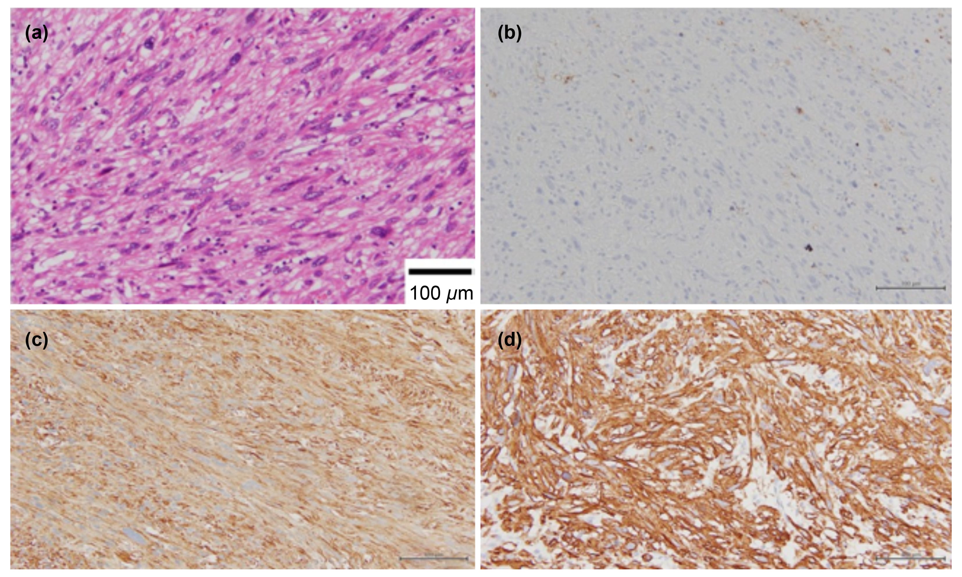 Histology of the spindle cell leiomyosarcoma component. (a)
H&E staining (×400): Proliferation of spindle-shaped tumor cells
showing nuclear pleomorphism and irregularity. (b) CD10 staining: Negative. (c)
Desmin staining: Positive. (d) Caldesmon staining: Positive.