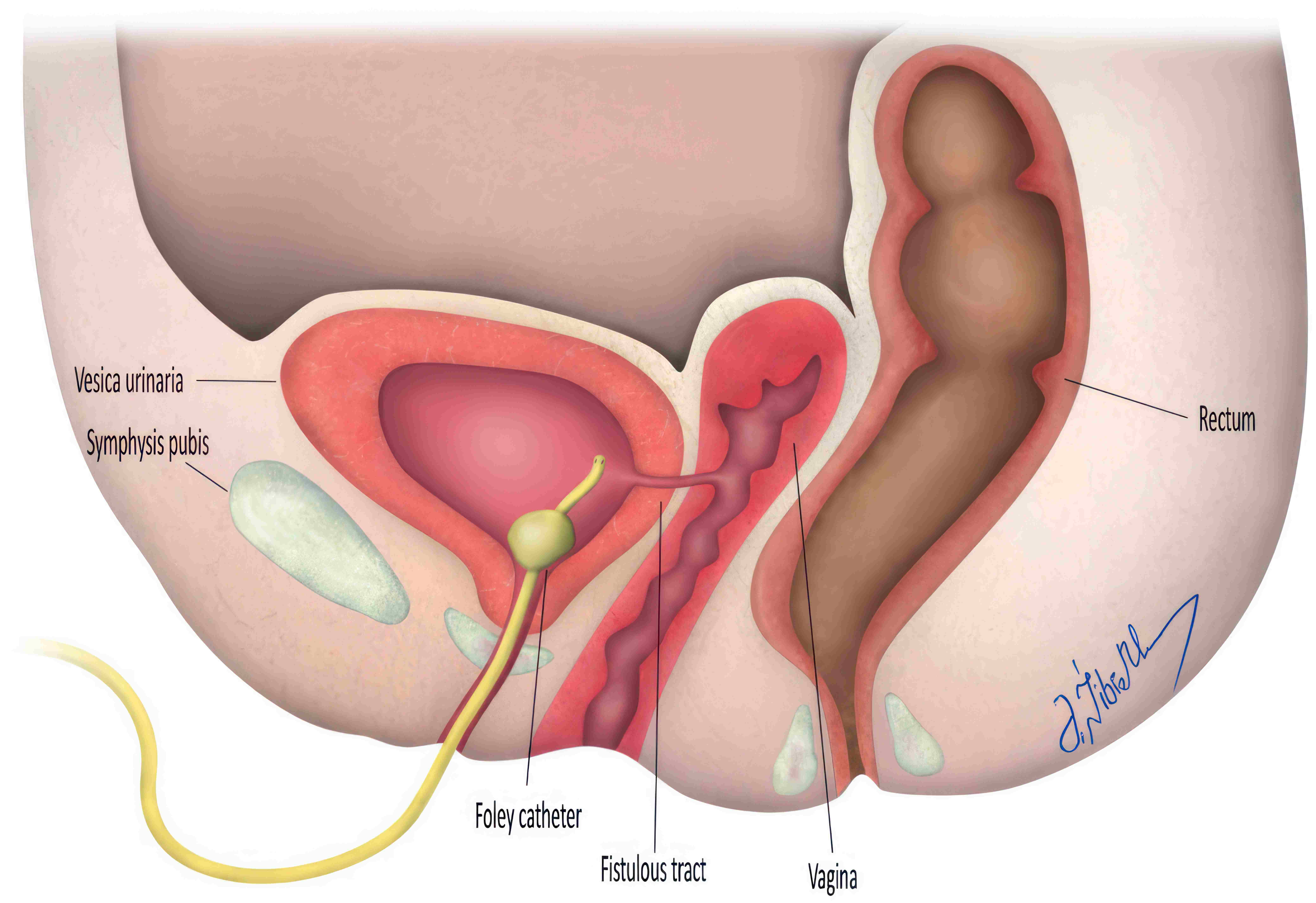 Schematic picture of vesicovaginal fistula.