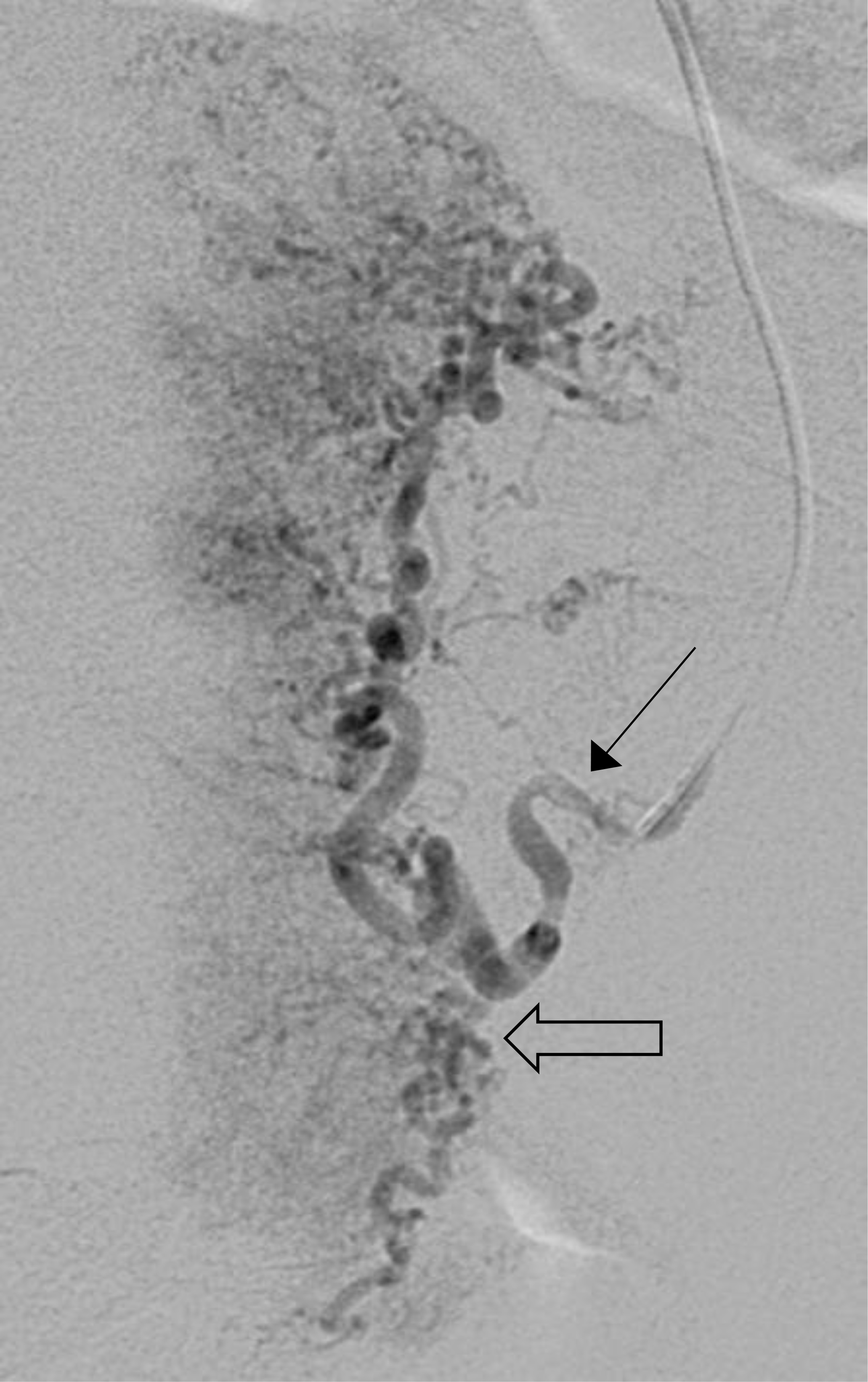 Angiogram of a cervical cancer patient 
presenting with vaginal hemorrhage. 37-year-old patient, presenting with vaginal 
hemorrhage. The patient had cervical epidermoid carcinoma, FIGO stage IIB, and 
was treatment-naive. Angiogram of the left uterine artery (arrow) shows 
hypertrophied cervicovaginal branches (open arrow).