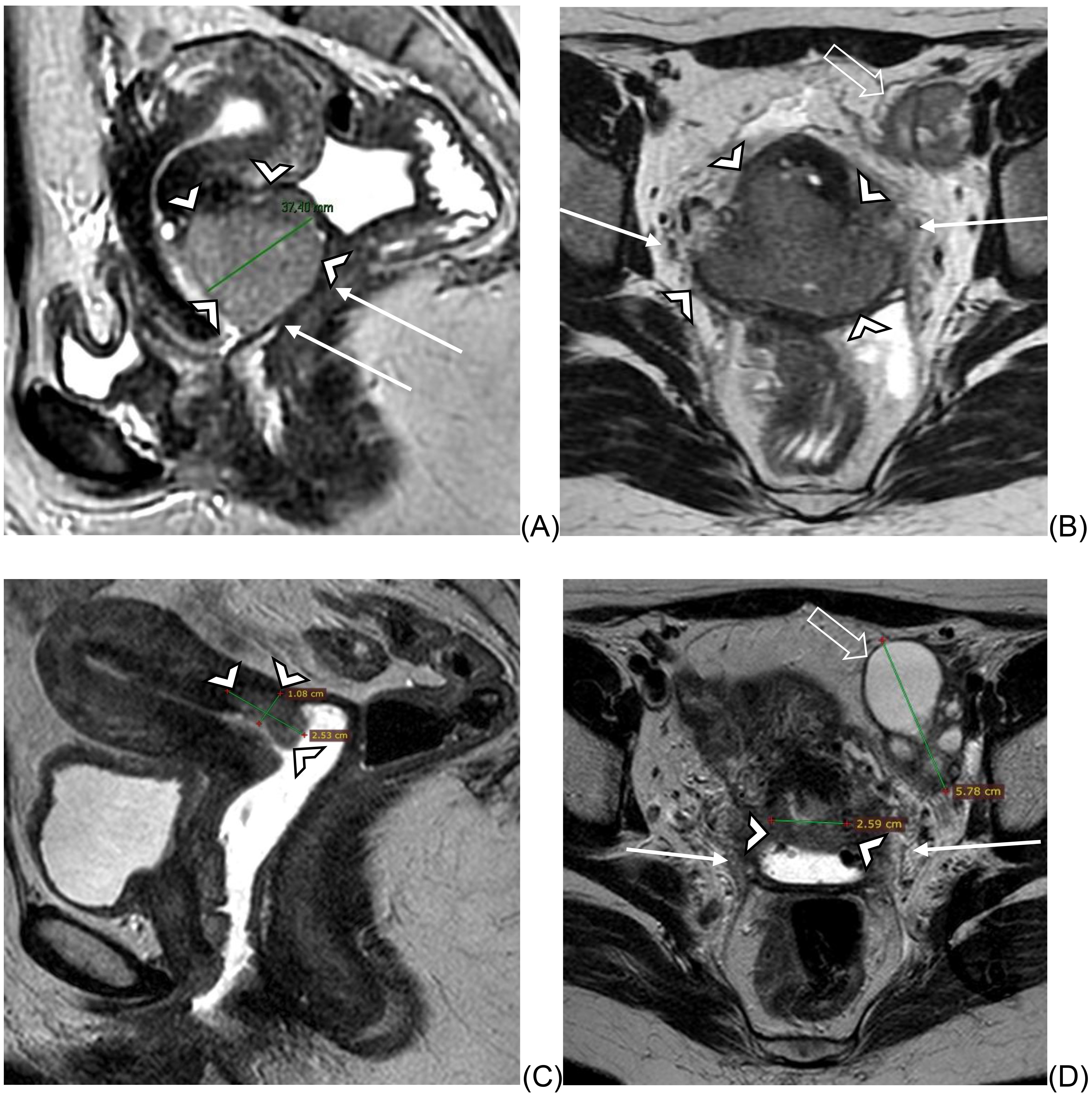 Magnetic resonance sequences of the same cervical cancer patient shown in Fig. 3, presenting with vaginal hemorrhage, before and after pelvic transarterial embolization (TAE). Magnetic Resonance T2W sequences of the same patient are 
represented. (A,B) images are prior embolization, showing the expansive lesion in 
the uterine cervix (arrowheads) measuring 4.1 × 7.4 × 5.1 cm, 
with bilateral parametrial extension (arrows B) and upper third of the vagina 
(arrows in A). Lymph node enlargement in the left external iliac chain (open 
arrow in B). (C,D) images are after embolization, showing reduction of tumor 
measures to 2.5 × 2.6 × 1.1 cm (arrowheads in C and D). 
Bilateral parametrial invasion is less visible (arrows in D). The external iliac 
lymph node has cystic degeneration (open arrow in D). The patient had no more 
vaginal hemorrhages.