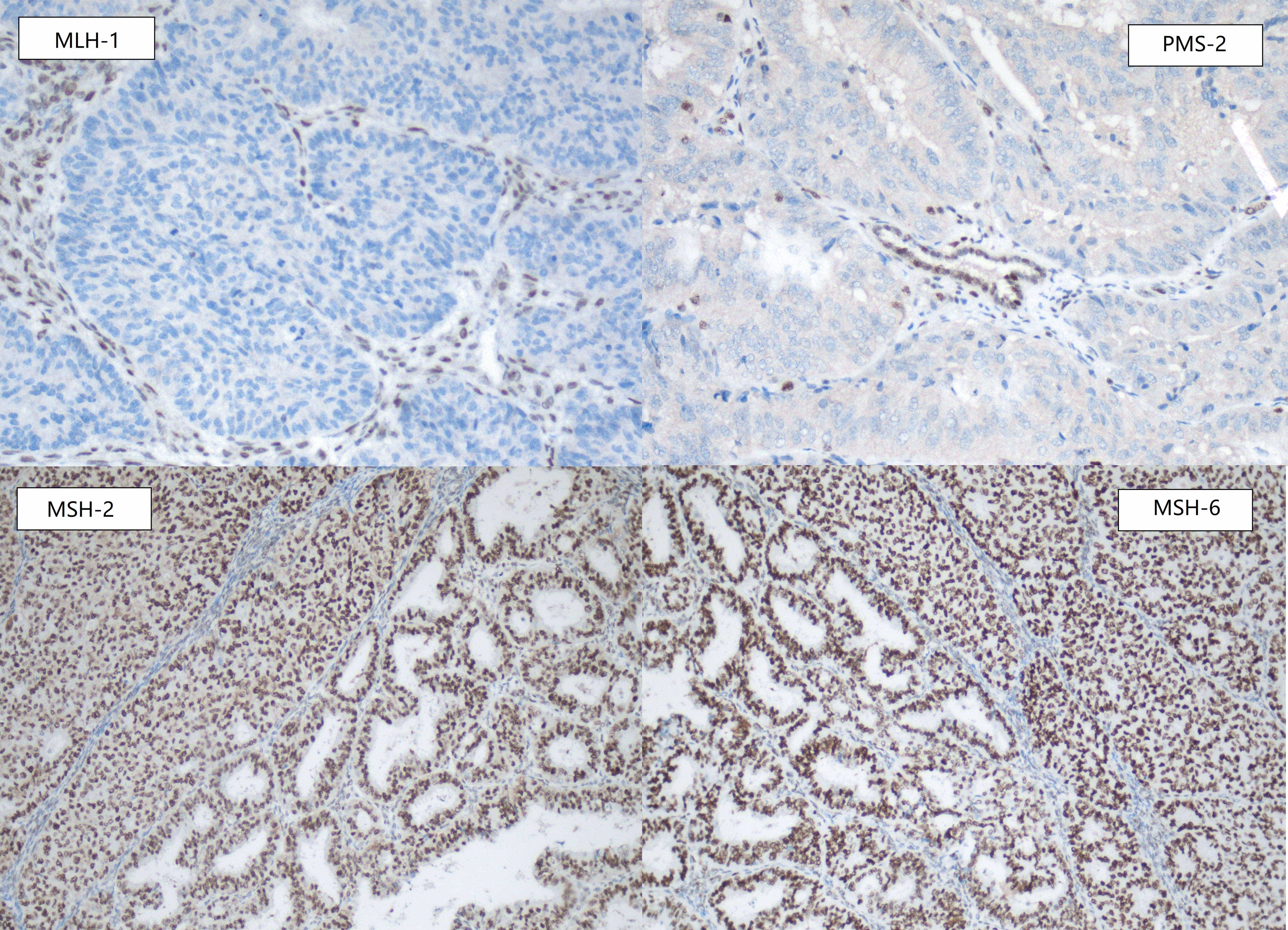 Immunohistochemical staining demonstrating loss of
MLH-1 and PMS-2 expression, with retained nuclear expression of
MSH-2 and MSH-6 (×200). Detection of all 4 MMR
proteins was performed on serial sections obtained from the same tumor tissue.
MLH-1: MutL Homolog 1; MSH-2: MutS Homolog 2;
MSH-6: MutS Homolog 6; PMS-2: PostMeiotic
Segregation increased 2.