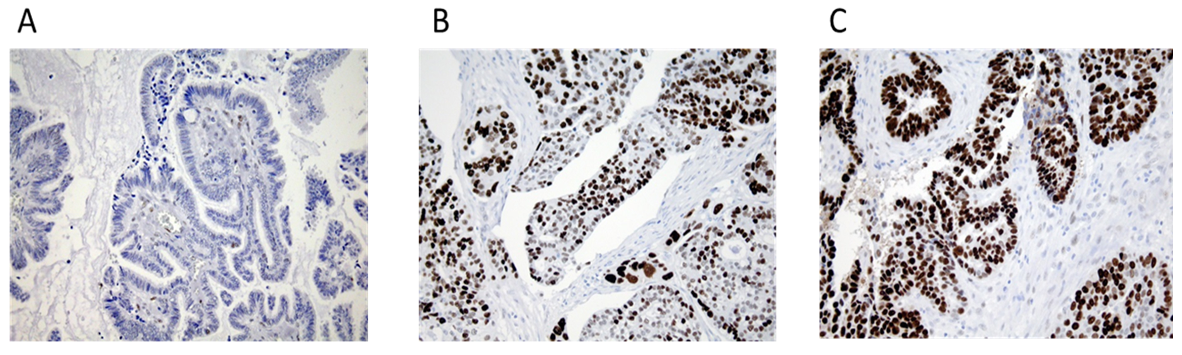 Examples of p53 immunohistochemical staining of tumor tissue.
(A) Tissue showing p53 negative staining in a highly differentiated serous
adenocarcinoma, FIGO stage III (0%) (objective ×40). (B) Tissue showing
60% p53 overexpression in a poorly differentiated serous adenocarcinoma, FIGO
stage III (objective ×40). (C) Tissue showing 100% p53 overexpression
in a poorly differentiated serous adenocarcinoma, FIGO stage III (objective
×40).