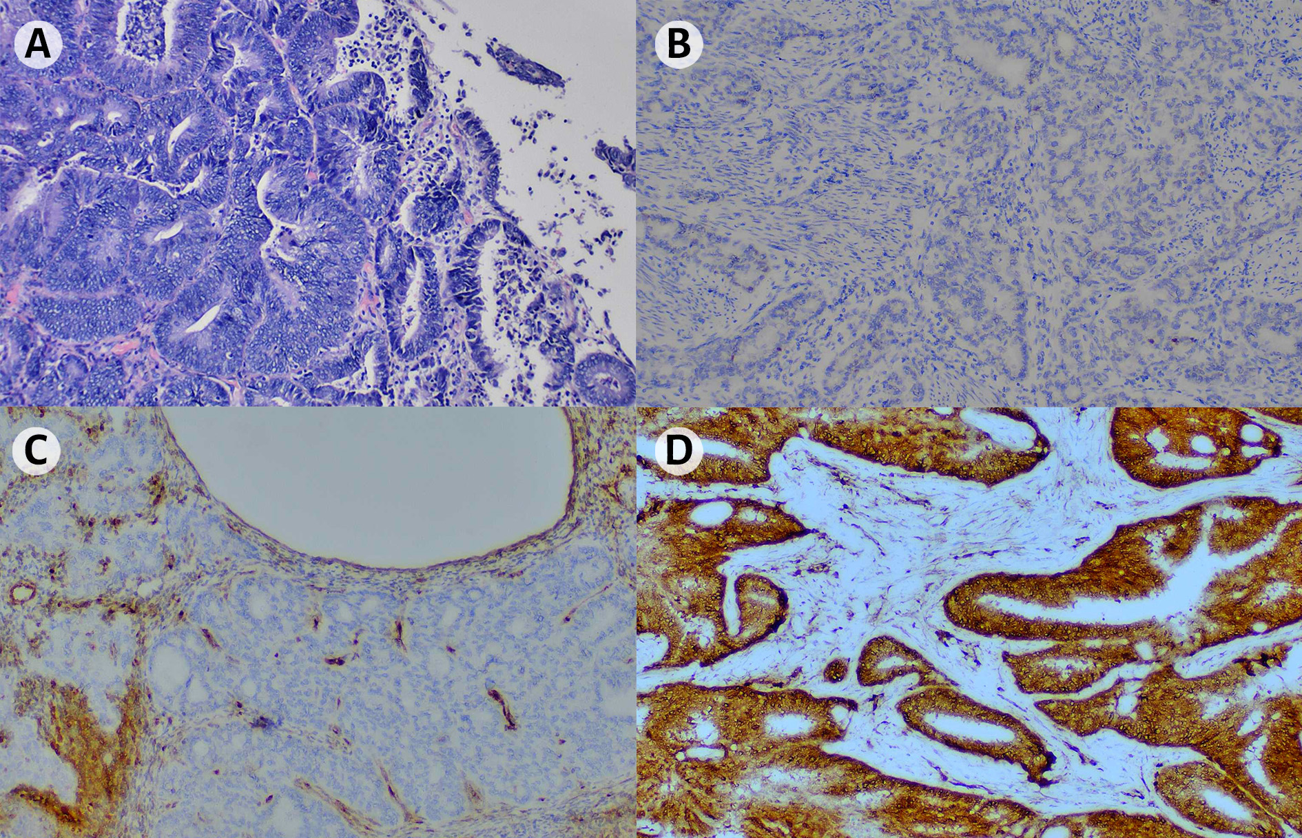 Representative histologic and immunohistochemical findings in
endometrial carcinoma. (A) Hematoxylin-eosin staining showing endometrioid
carcinoma G2 ×10. (B) Aberrant p53 expression (null pattern) G2
×10. (C) Loss of PTEN expression in tumor cells G2 (score 0)
×10. (D) Strong PTEN expression showing intense cytoplasmic staining in
tumor cells G2 (score 12) ×10. Panels A–C are from the same tumour,
whereas panel D represents a different tumour. All tumours correspond to
endometrioid carcinoma, grade 2.