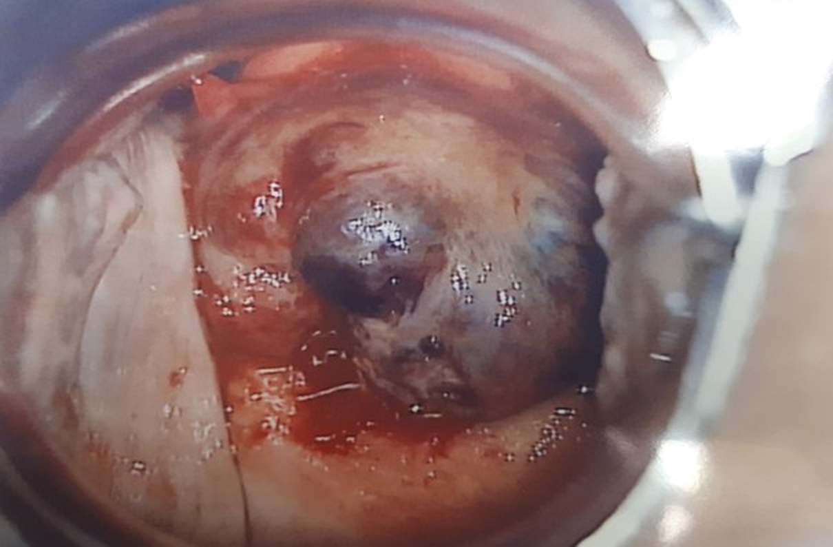 Pelvic examination revealed a dark, hemorrhagic mass measuring
approximately 5 cm on the anterior lip of the uterine cervix.