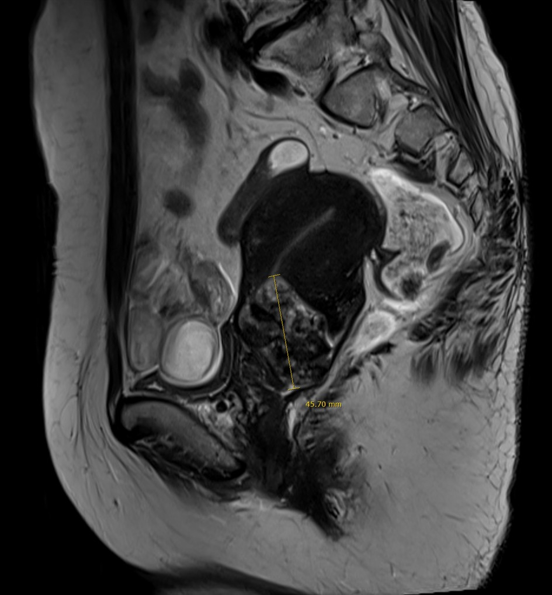 Pelvic magnetic resonance imaging (MRI) demonstrated a
heterogeneously enhancing, ill-defined mass measuring 3.7 × 3.4
× 4.6 cm located at the anterior lip of the uterine cervix. On
T2-weighted imaging, the lesion exhibited heterogeneous signal intensity with
areas of intratumoral hemorrhage. Diffusion restriction was not prominent. The
mass appeared to invade both cervical stromal regions.