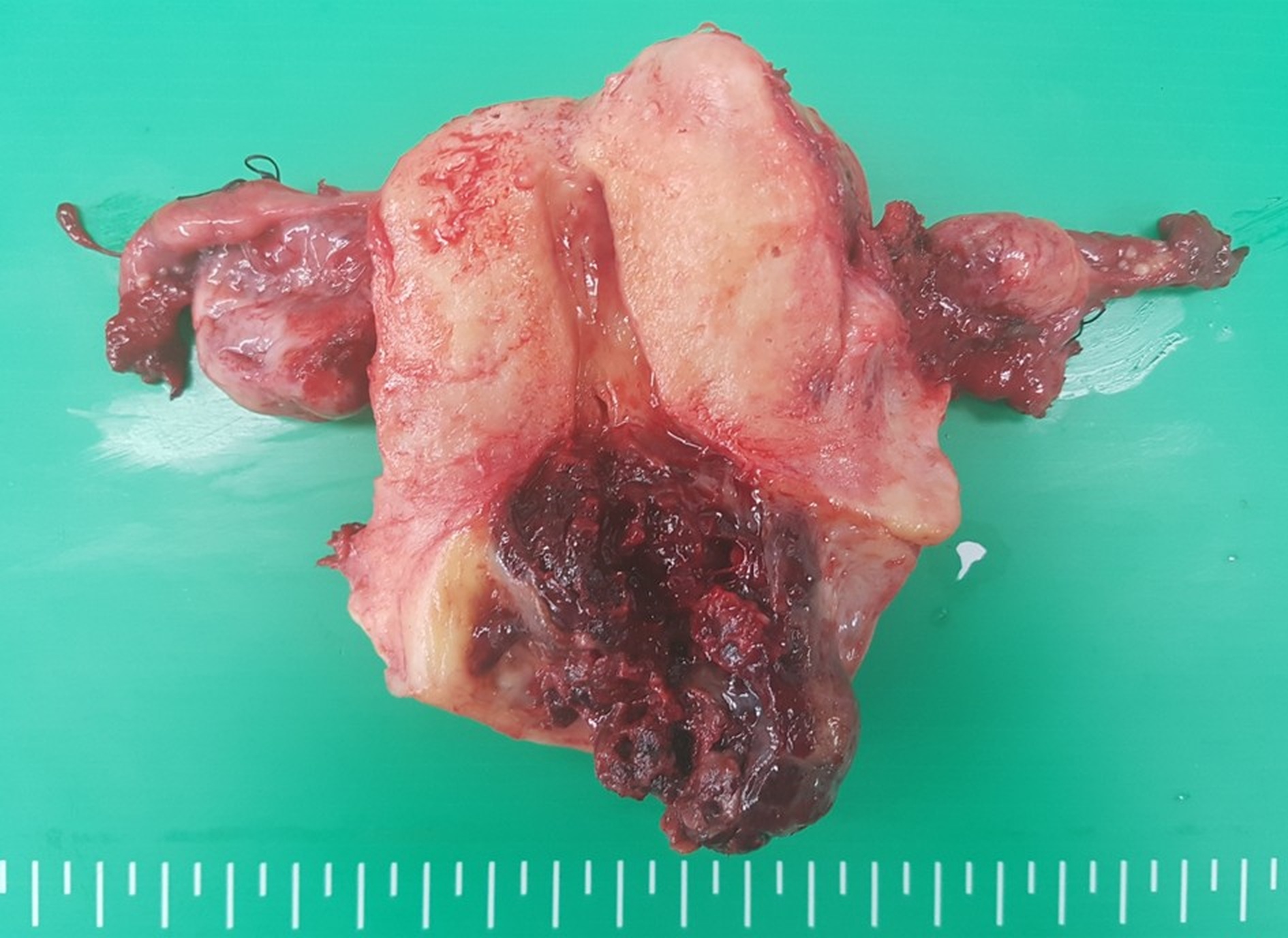 Gross examination of the uterine cervical tumor revealed a dark,
hemorrhagic, necrotic mass measuring approximately 5 cm in diameter. A bisected
view of the excised uterus showed full-thickness stromal invasion of the cervix.
Both ovaries and fallopian tubes appeared intact, with no gross abnormalities.