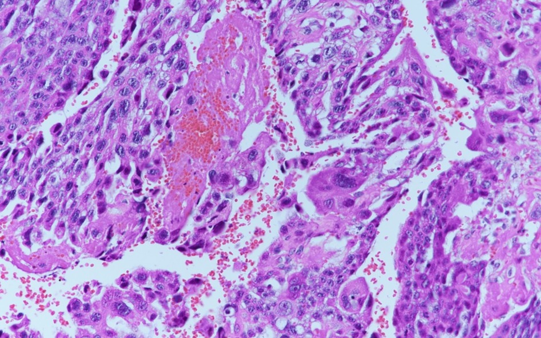 Histopathological examination demonstrated an atypical admixture
of cytotrophoblasts and syncytiotrophoblasts (hematoxylin and eosin,
×100). Immunohistochemical staining showed positive expression of
β-human chorionic gonadotropin (β-hCG).