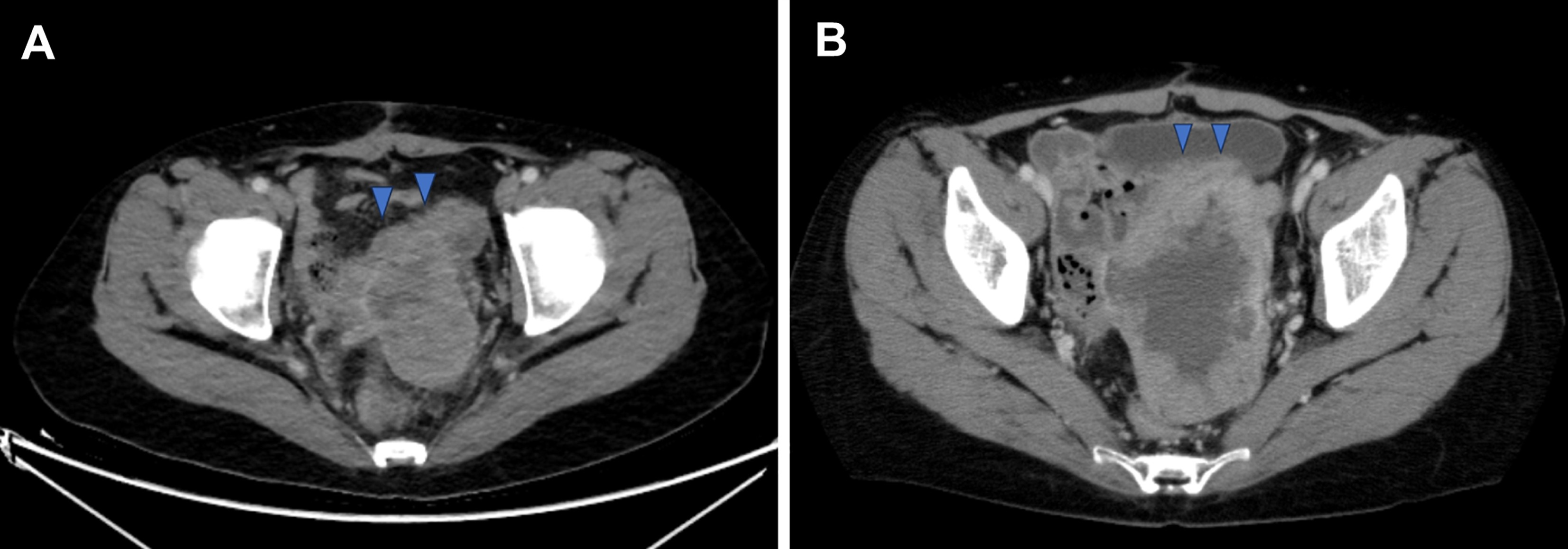 Contrast-enhanced computed tomography (CT), axial view. At the site of vaginal stump recurrence (A) and after completion of chemotherapy 
(B), the lesion had enlarged and exhibited internal necrosis.