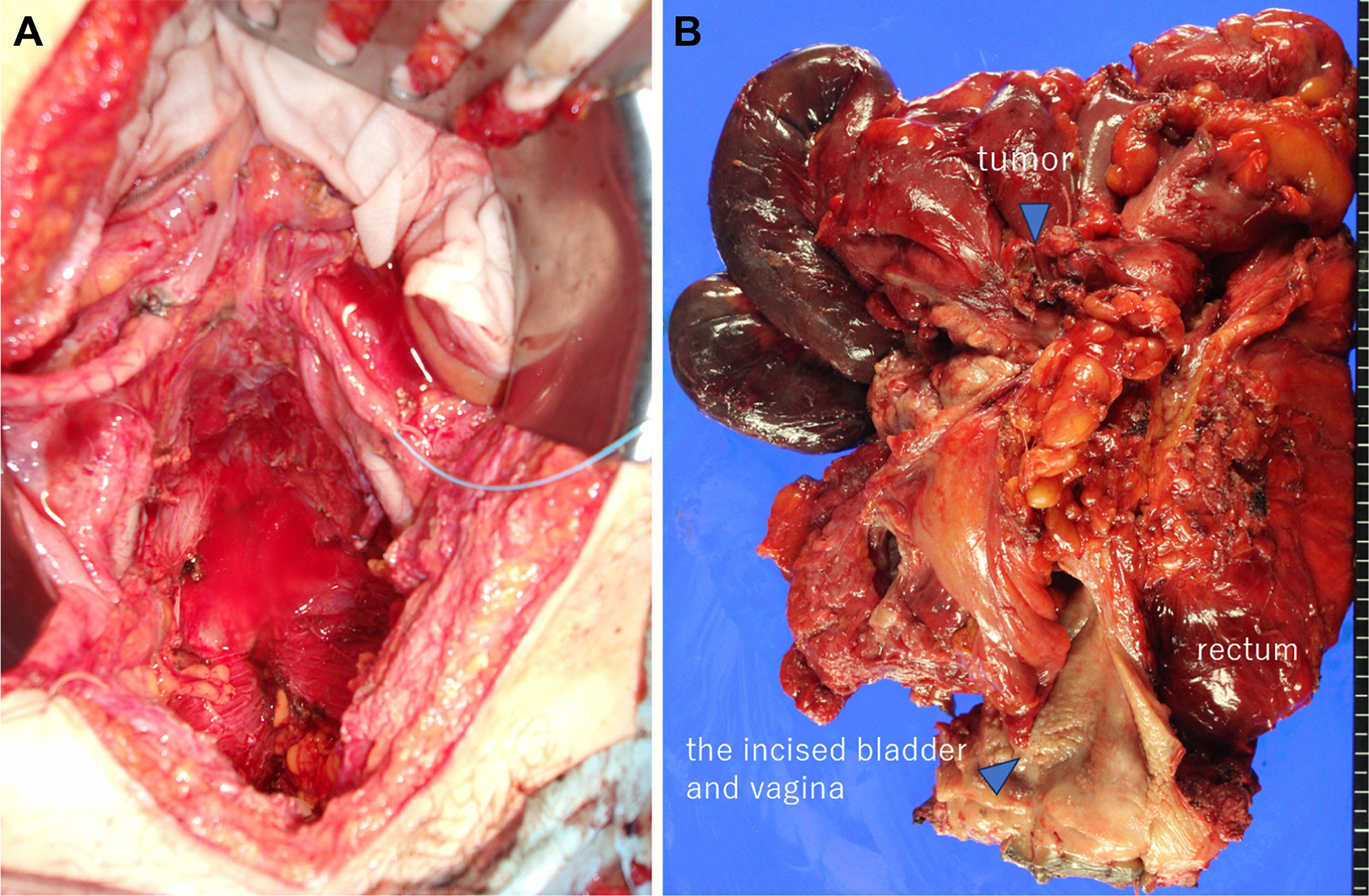 Intraoperative findings after tumor resection (A) and 
the corresponding surgical specimens (B). The bladder, vagina, small intestine, 
and colon were completely resected en bloc, with the tumor indicated by 
an arrow.