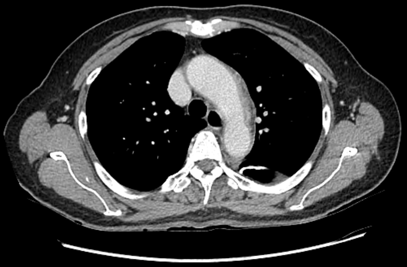 Contrast-enhanced chest computed tomography (CT) demonstrating circumferential mural thickening and perivascular inflammation involving
the aortic arch, proximal descending thoracic aorta, left proximal
common carotid artery, and left proximal subclavian artery.
