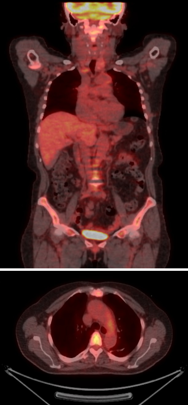 Fluorodeoxyglucose-positron emission tomography (FDG-PET)
showing increased FDG uptake consistent with inflammation of the large vessels
involving the aortic arch, proximal descending aorta, left proximal common
carotid artery, and left proximal subclavian artery.